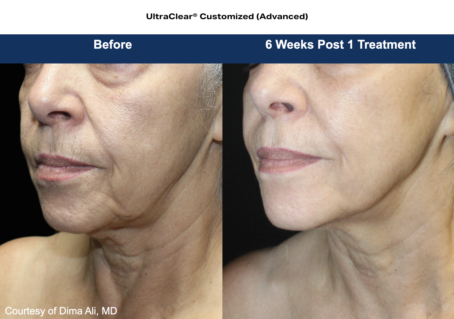 ultraclear customized before and after results
