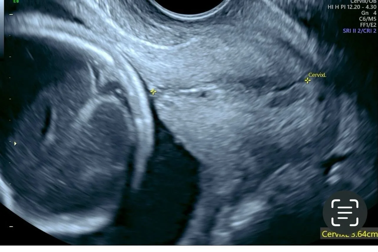 Why is the cervix important in pregnancy?
The bottom part of the uterus, the vital part that I call &ldquo;the gatekeeper&rdquo;, the cervix is usually rubber like in texture and easy to find (despite discomfort of the dreaded Pap smear). It has a cr