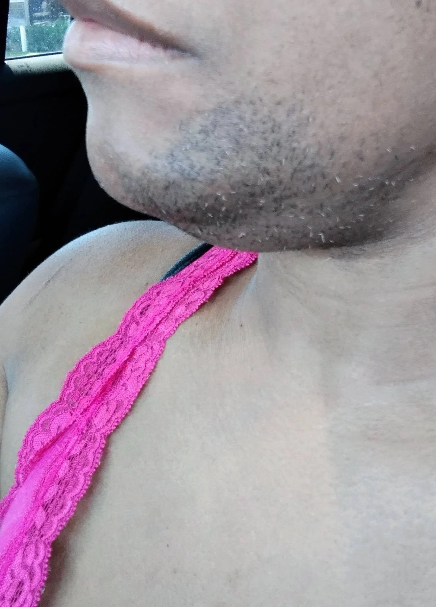 S.G. close up of client chin before treatment. Left side view.