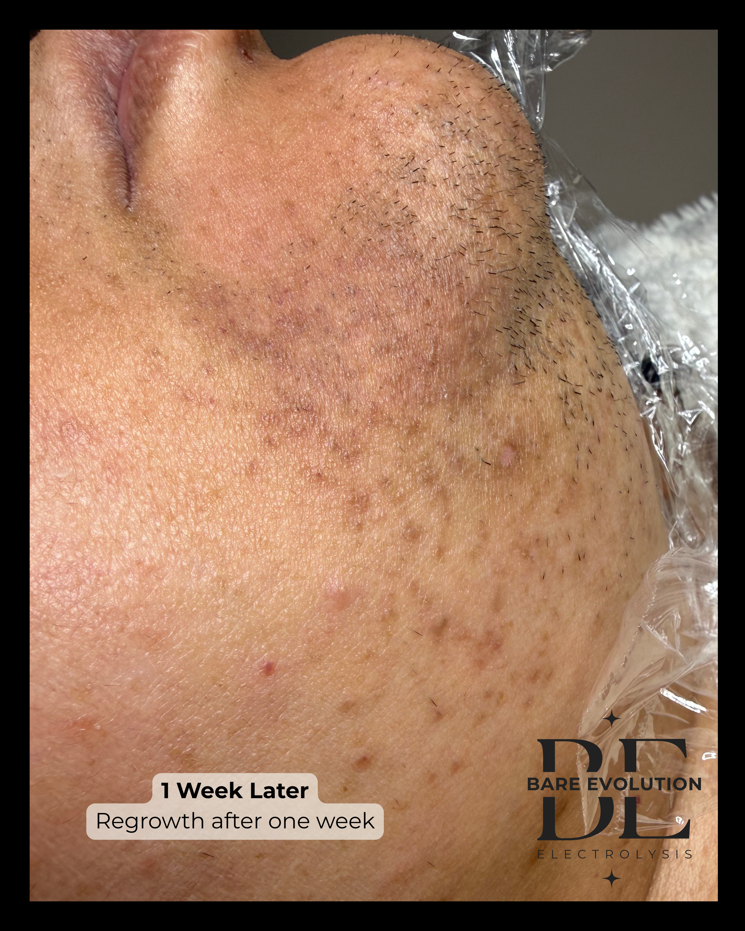 Close up of client chin with hormonal hair growth showing skin healing 1 week after first appointment.