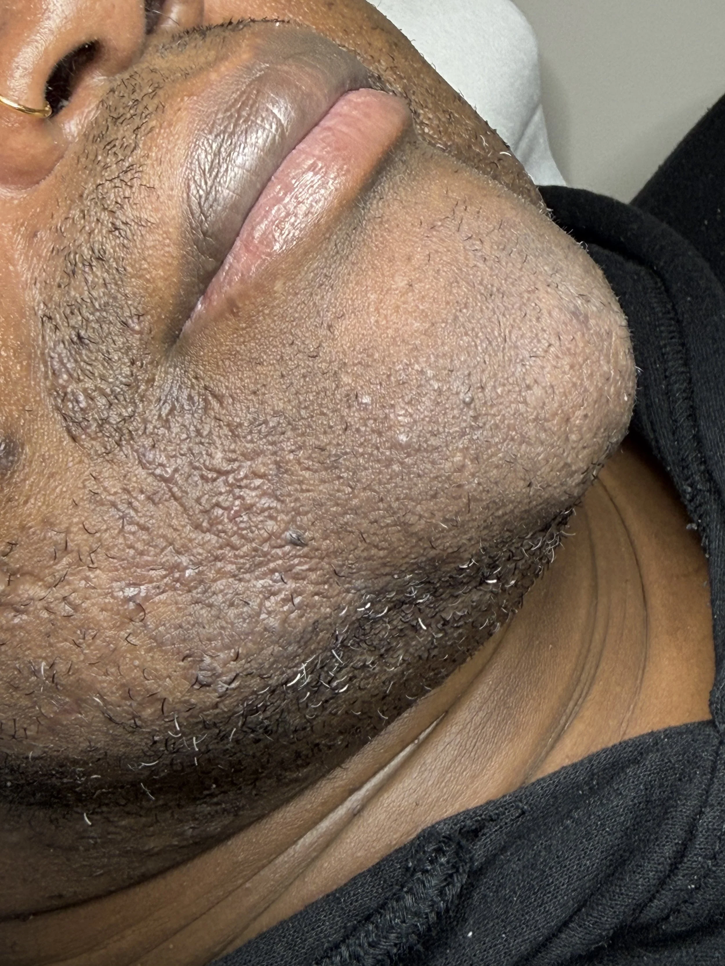 T.B. after 5 months of consistent electrolysis treatment. Front view.