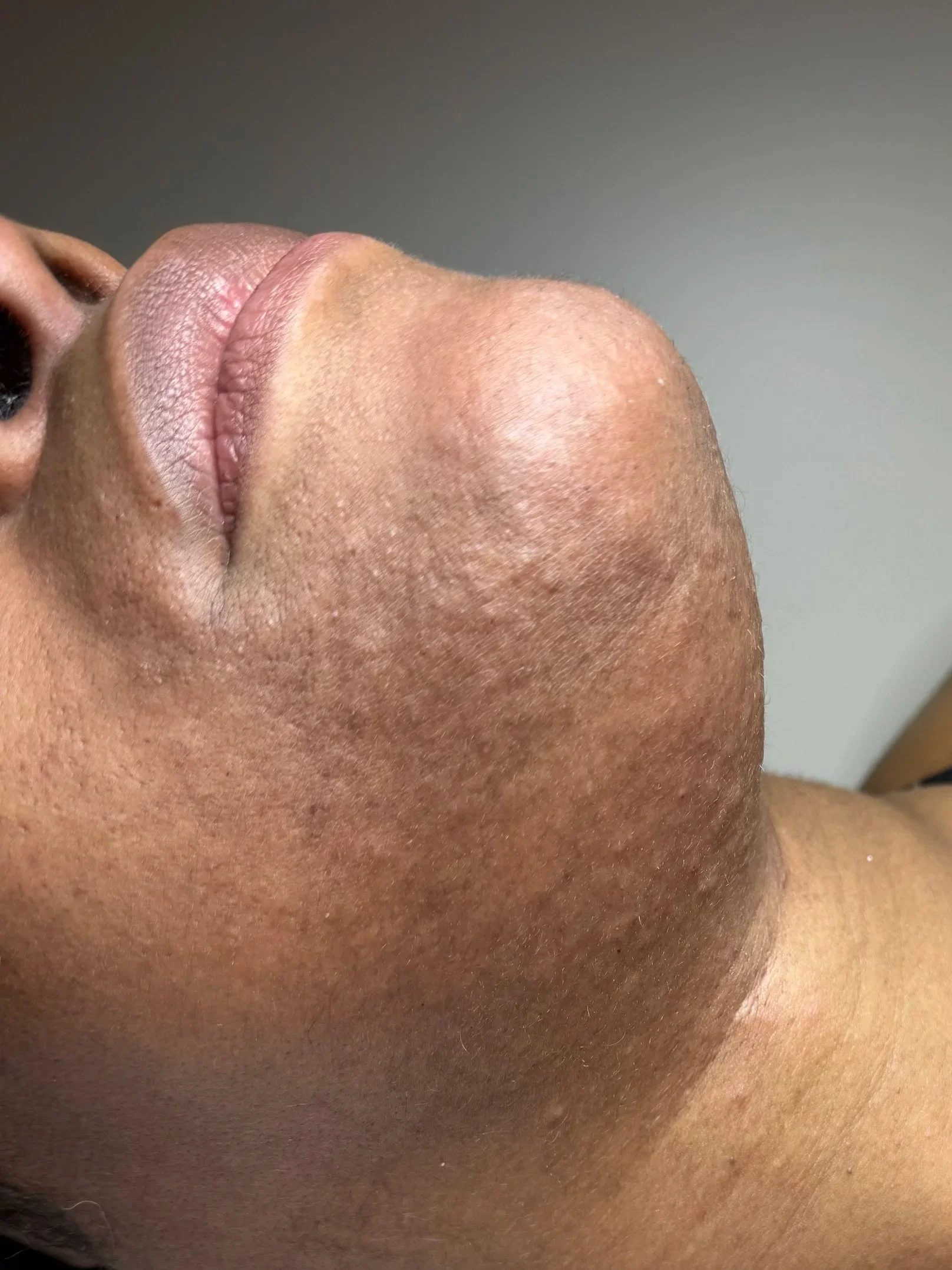 S.G. close up of client chin after consistent electrolysis treatment showing much less hair after 9 months. Directly after treatment.