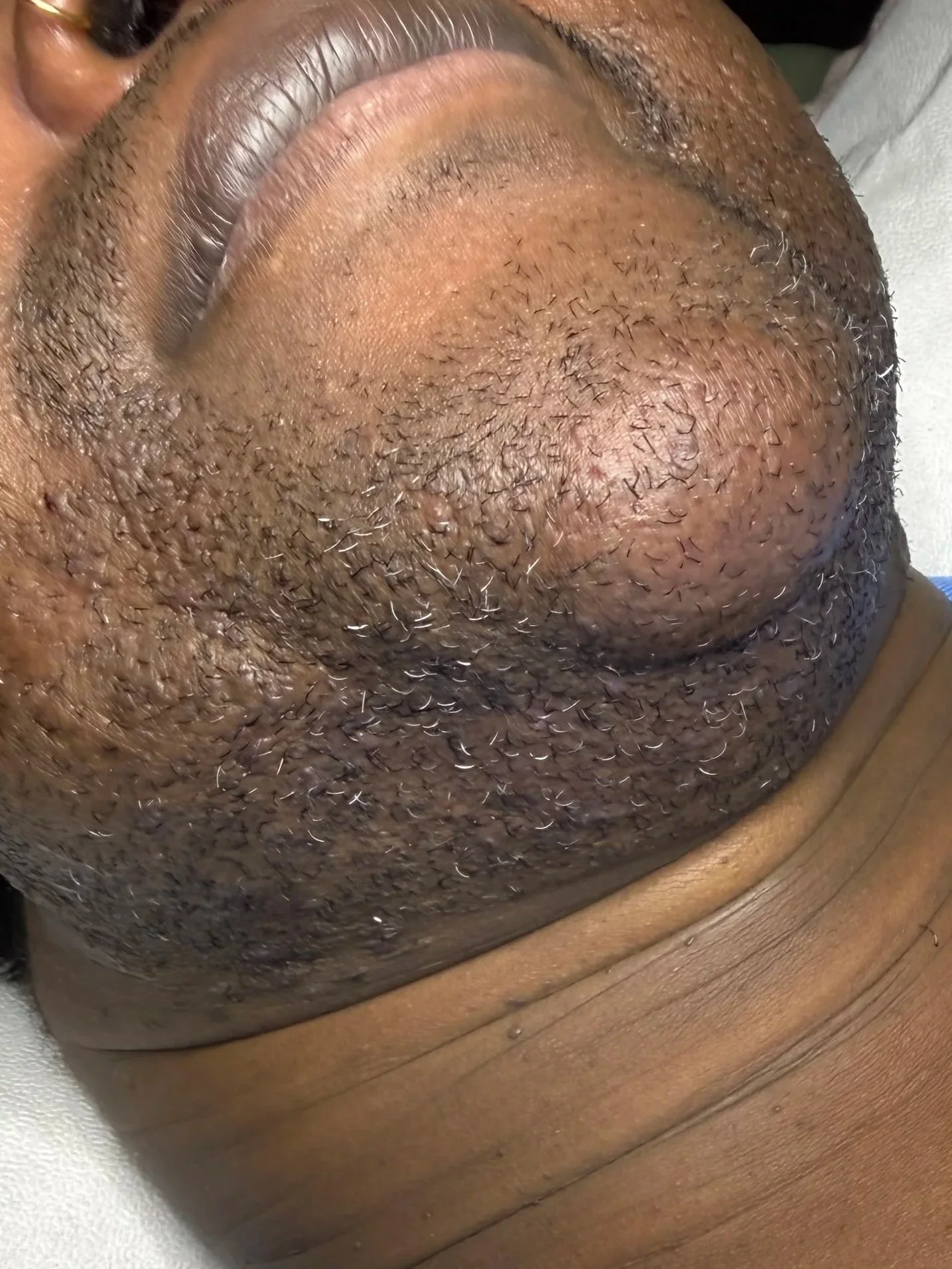 T.B. at the beginning of their electrolysis journey. Front view.