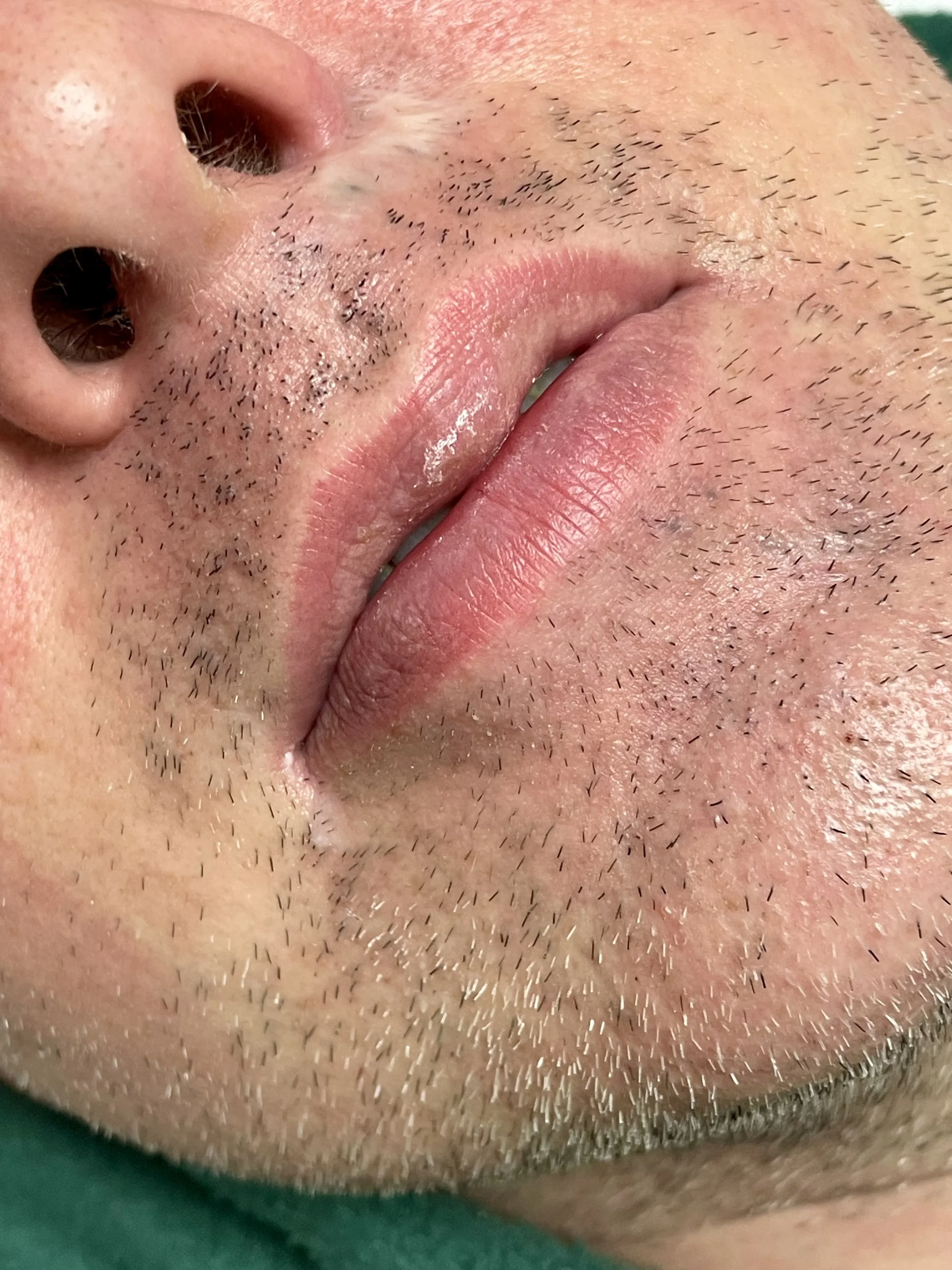 Photo shows a close up of a trans client's before photo of their upper lip and chin hair.