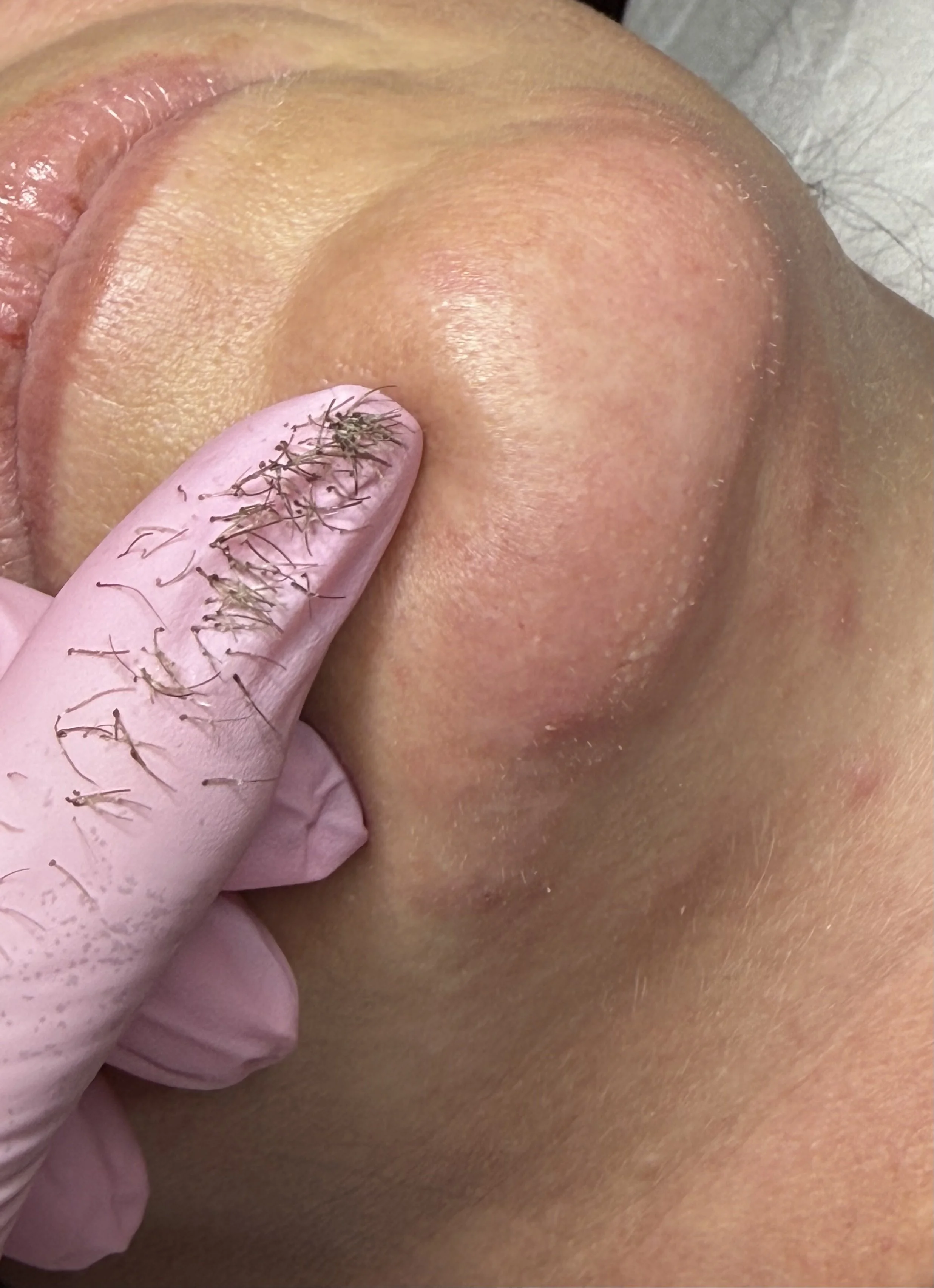 Client chin with all of the hair removed showing smooth skin.