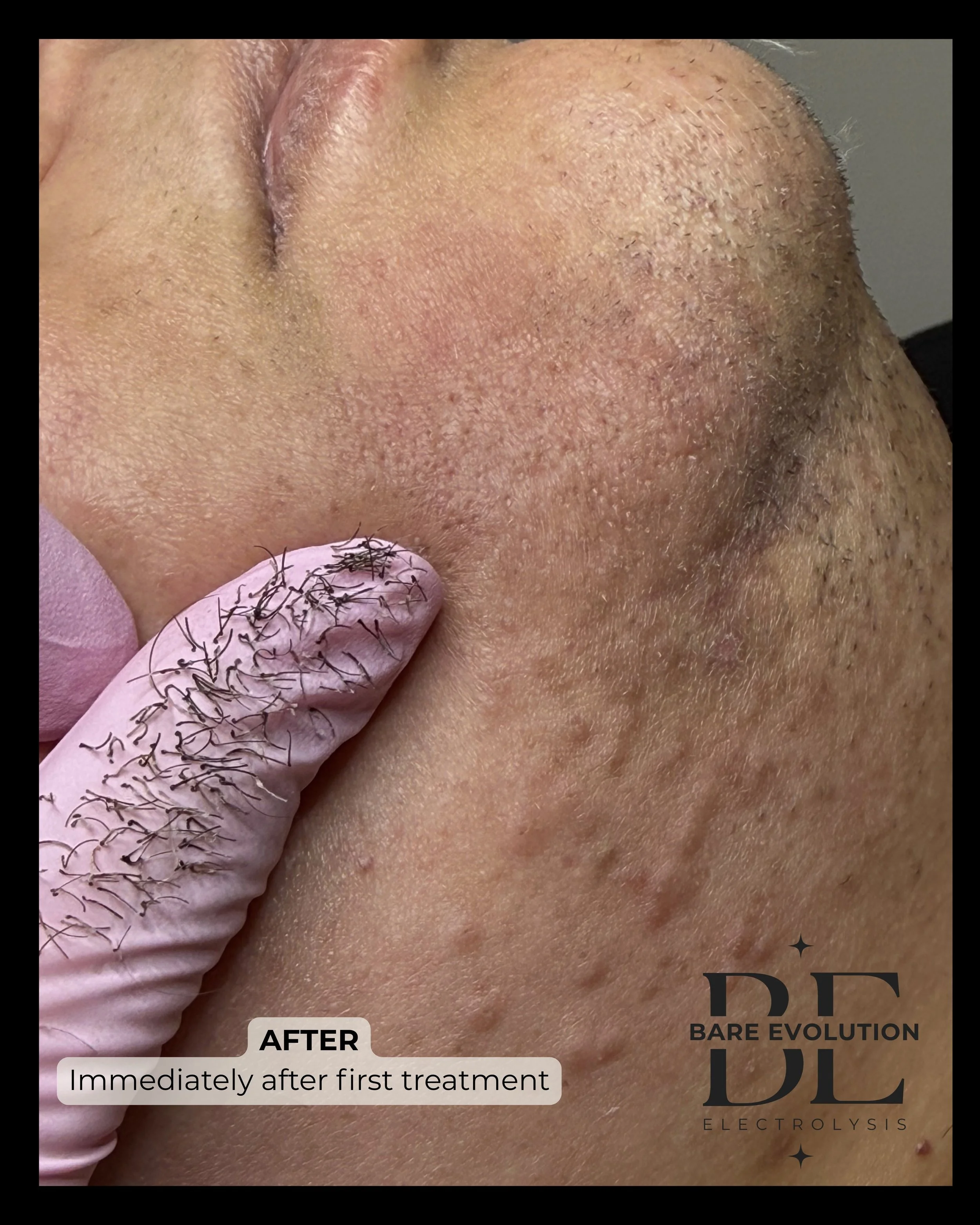 Close up of client with hormonal hair growth on chin immediately after first treatment showing skin reaction and the hair removed.