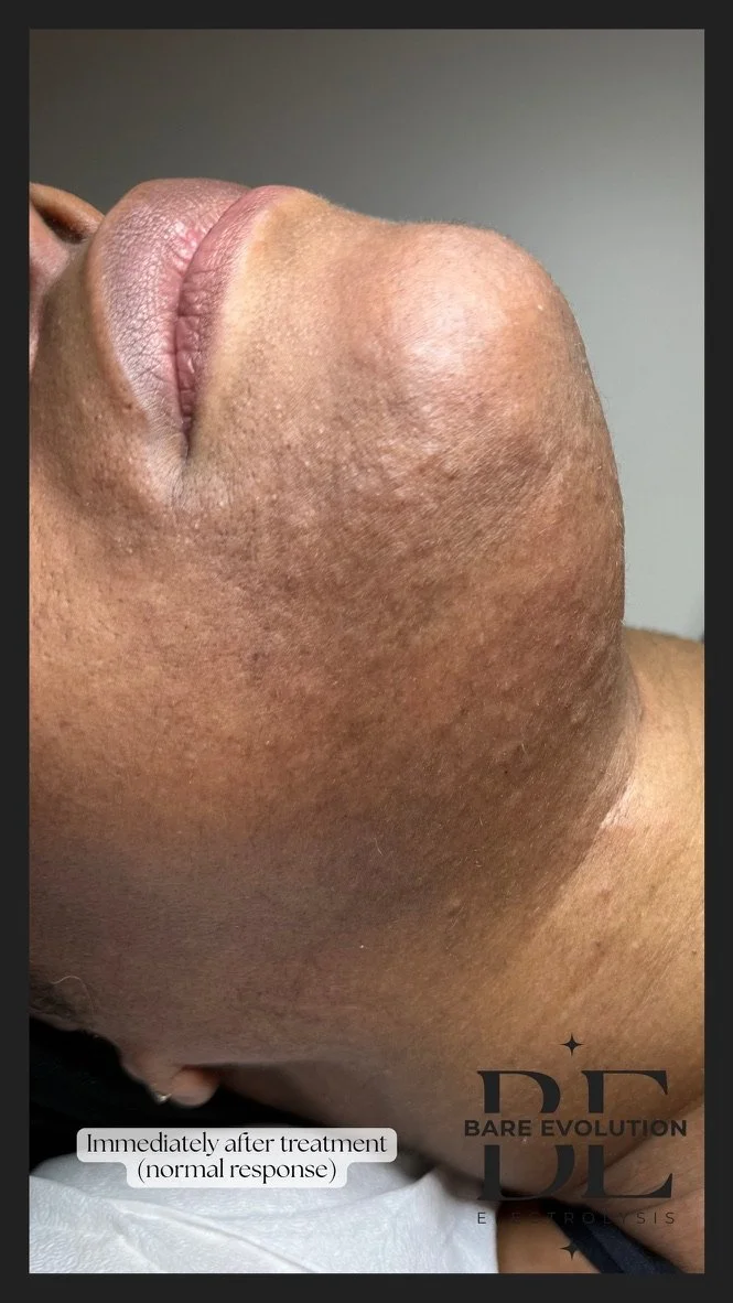 Close up of richly melanated client's chin showing 9 months of progress after consistent electrolysis treatment. After treatment. Major reduction in amount and coarseness of hair.
