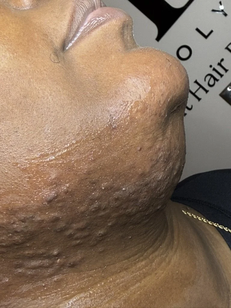 Close up of richly melanated client chin after hair has been removed through electrolysis treatment.