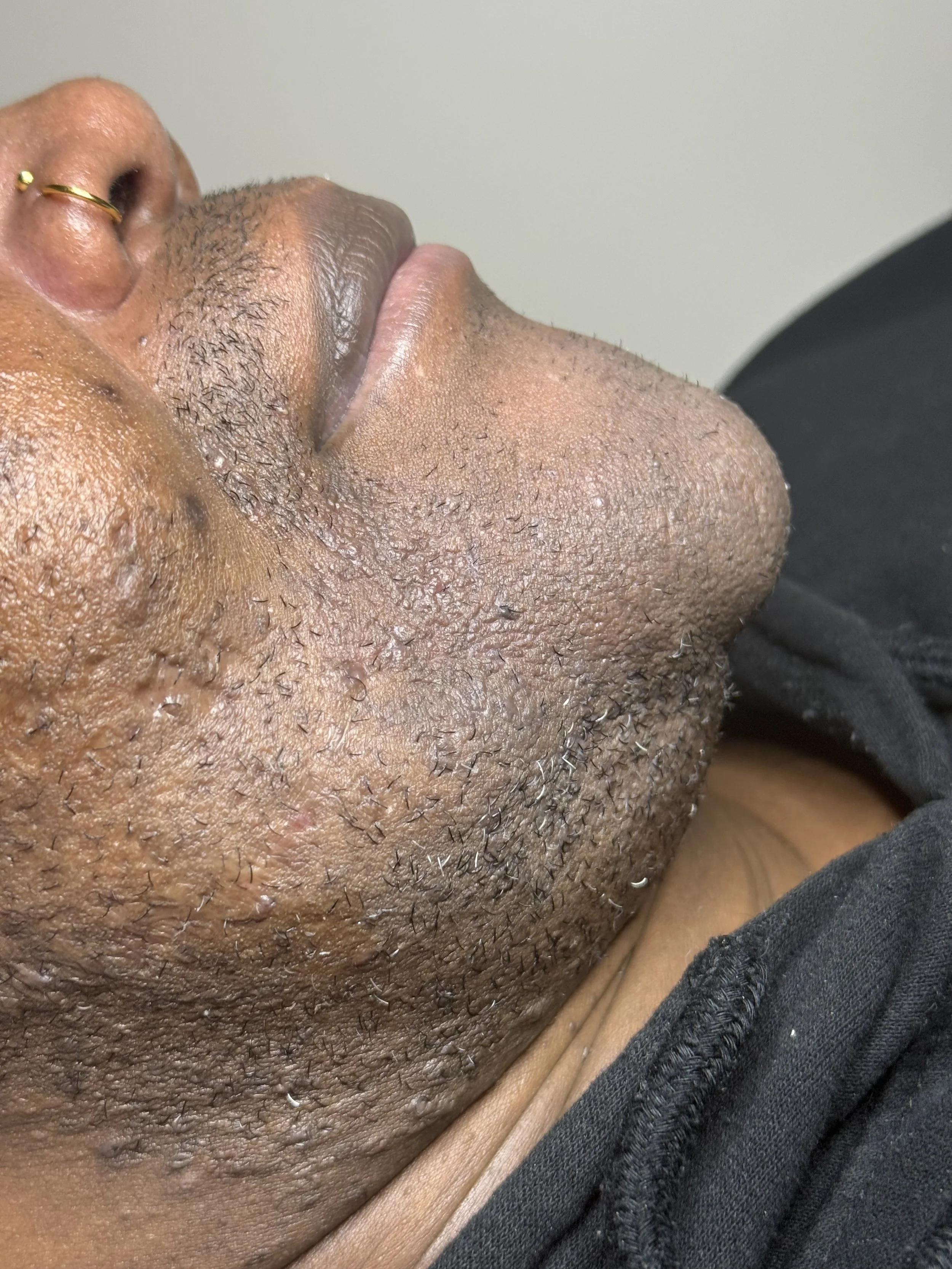 Close up of richly melanated trans client's chin after 5 months of treatment showing dramatically less hair regrowth after 5 months of treatment. Side view.