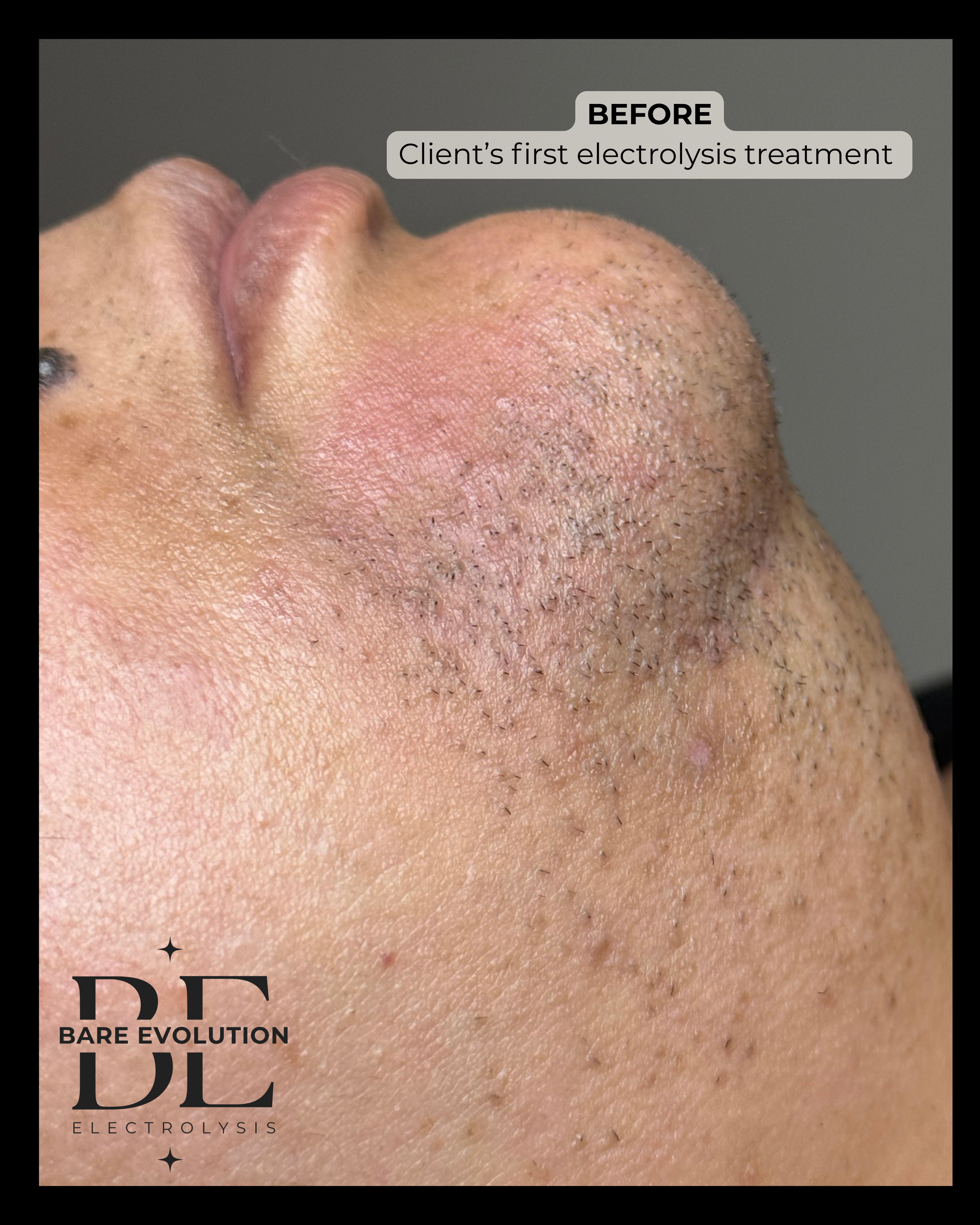 Close up of client chin before starting electrolysis showcasing hormonal hair growth on the chin.