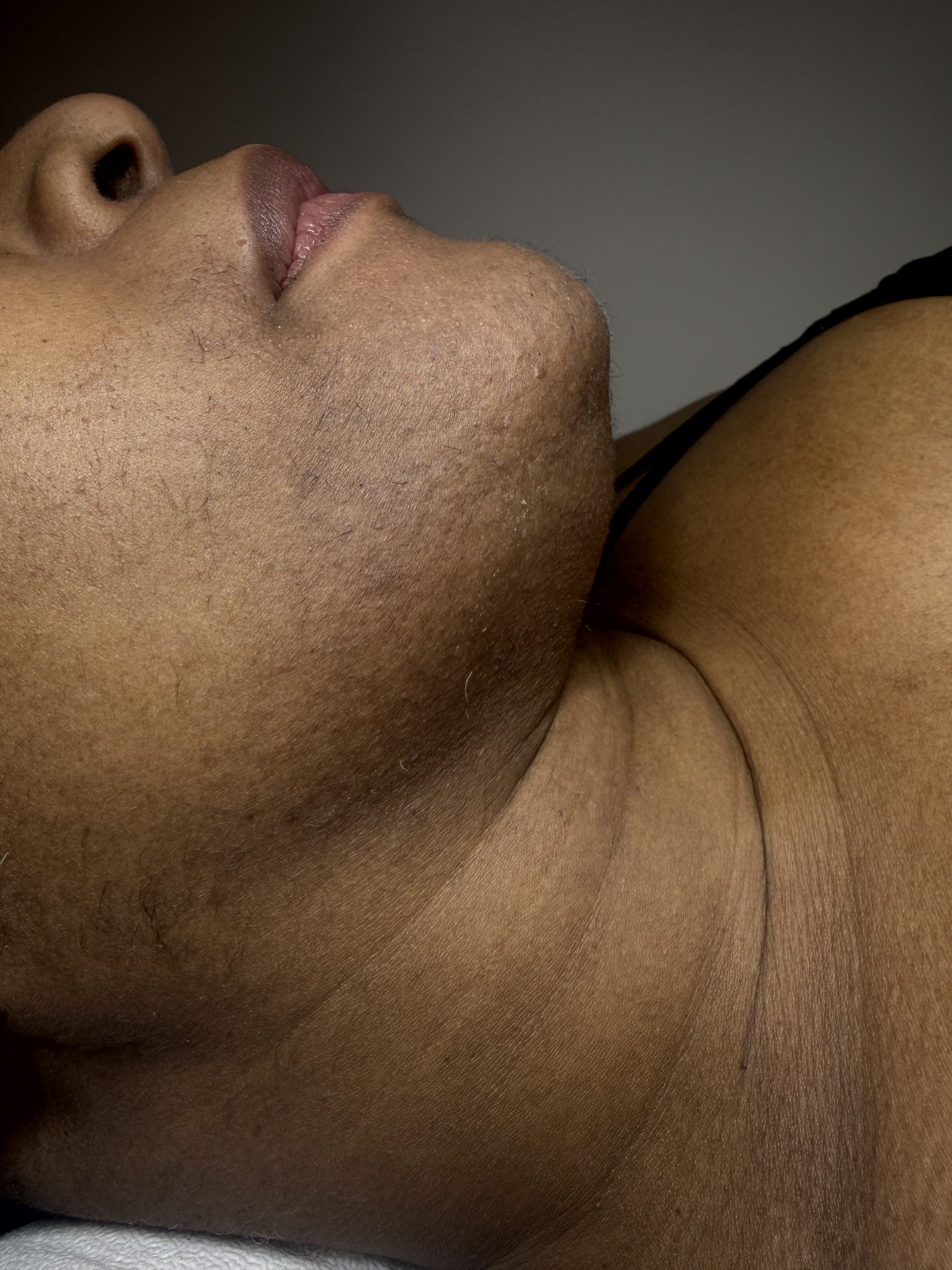 S.G. close up of client chin after consistent electrolysis treatment showing much less hair after 9 months.