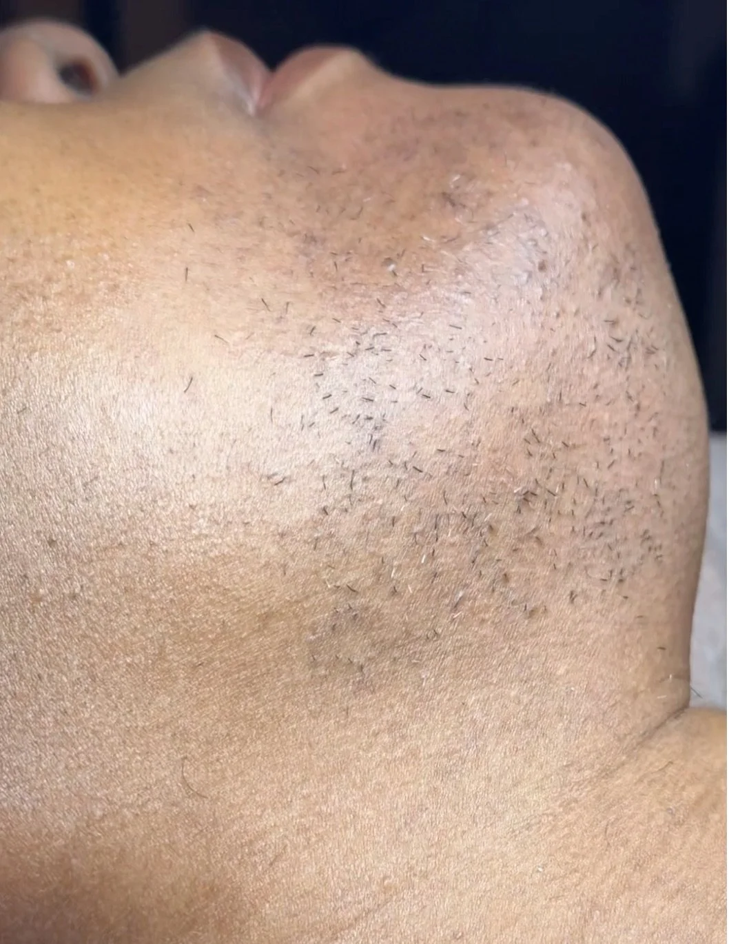 Close up of richly-melanated client chin showing coarse hair after multiple thinning sessions. Right side.