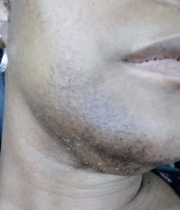 Close up of richly melanated client chin showing coarse hair prior to beginning electrolysis treatment.