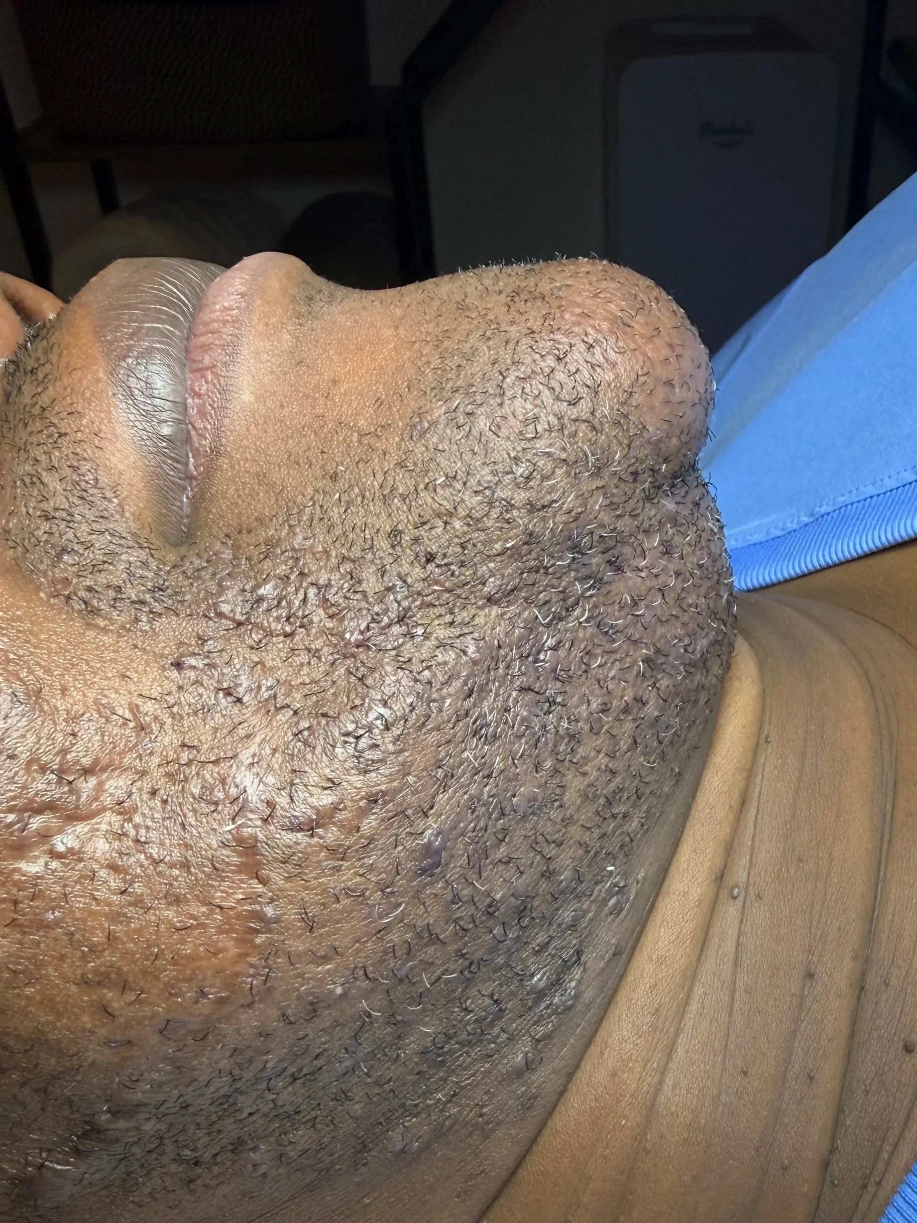 Close up of richly melanated trans client's chin before treatment showing dense coarse beard hair.