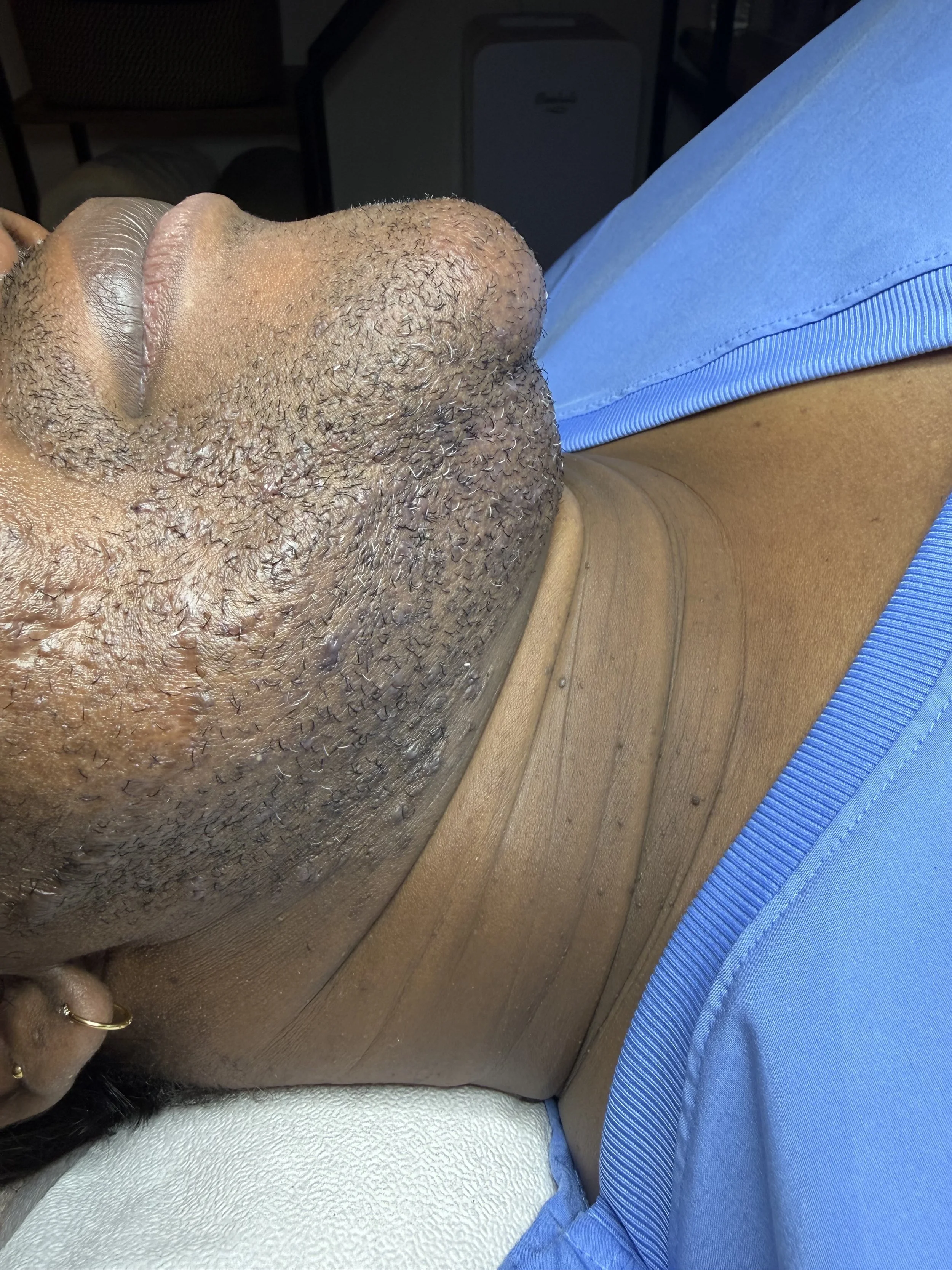 T.B. at the beginning of their electrolysis journey. Side view.