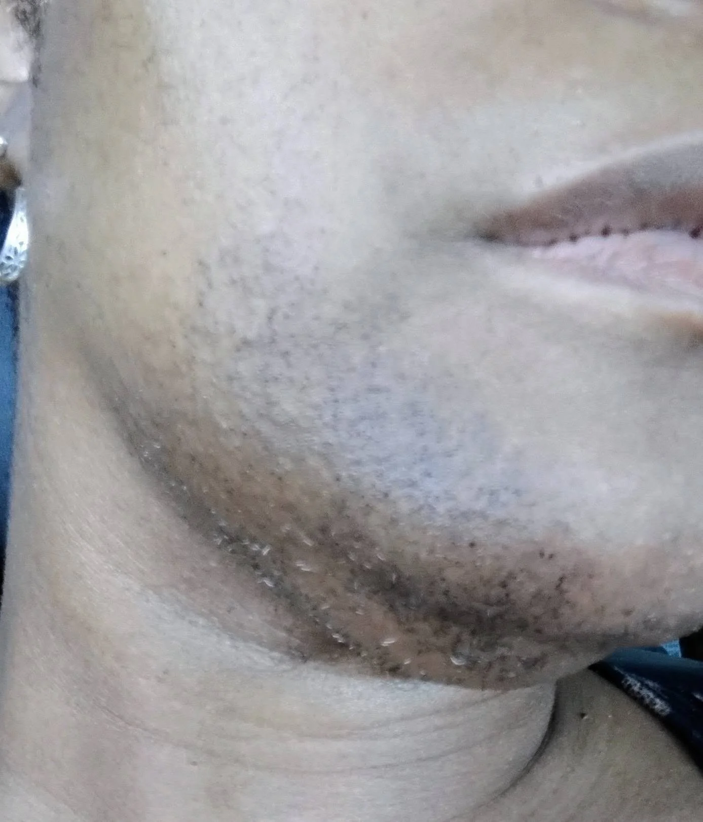 S.G. close up of client chin before treatment. Right side view.