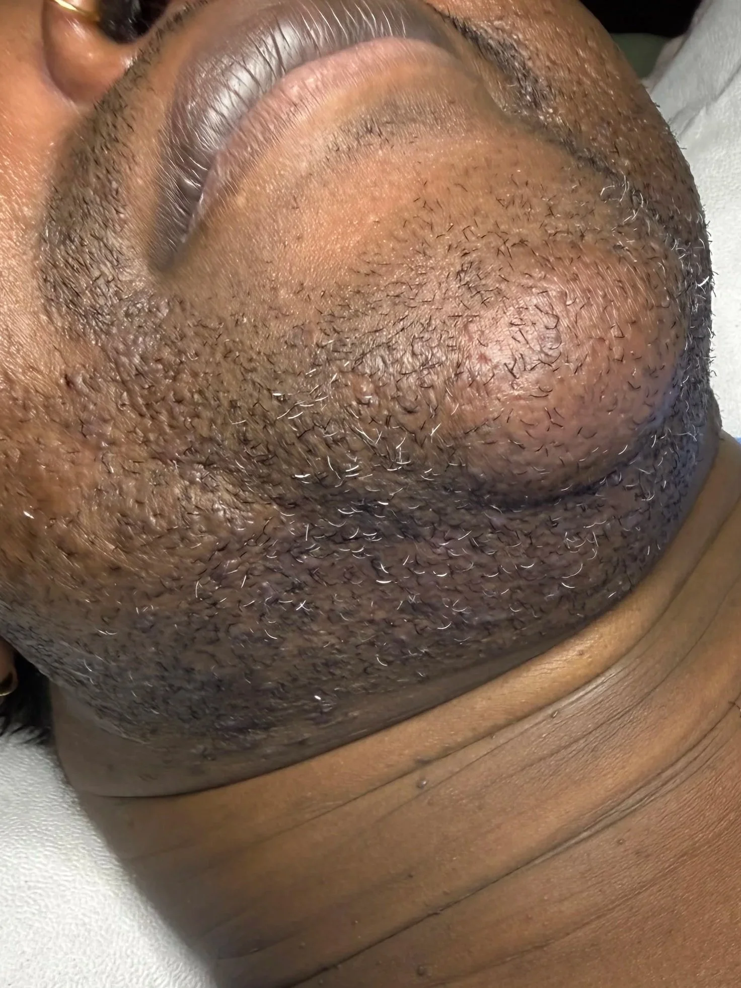 Close up of richly melanated trans client's chin before treatment showing coarse and dense chin hair. Front view.