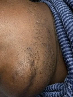 Richly melanated client jawline showing thick coarse growth before starting electrolysis treatment.