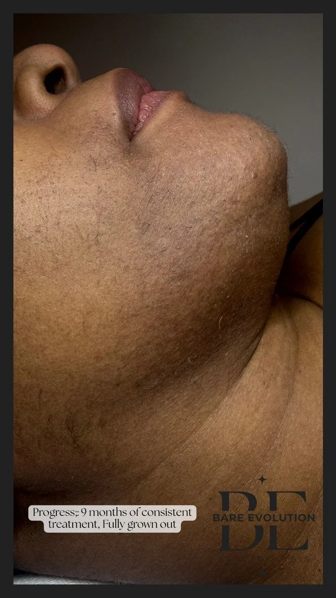 Close up of richly-melanated client chin showing coarse hair after multiple thinning sessions. Before treatment showing diminished and finer hair growth.