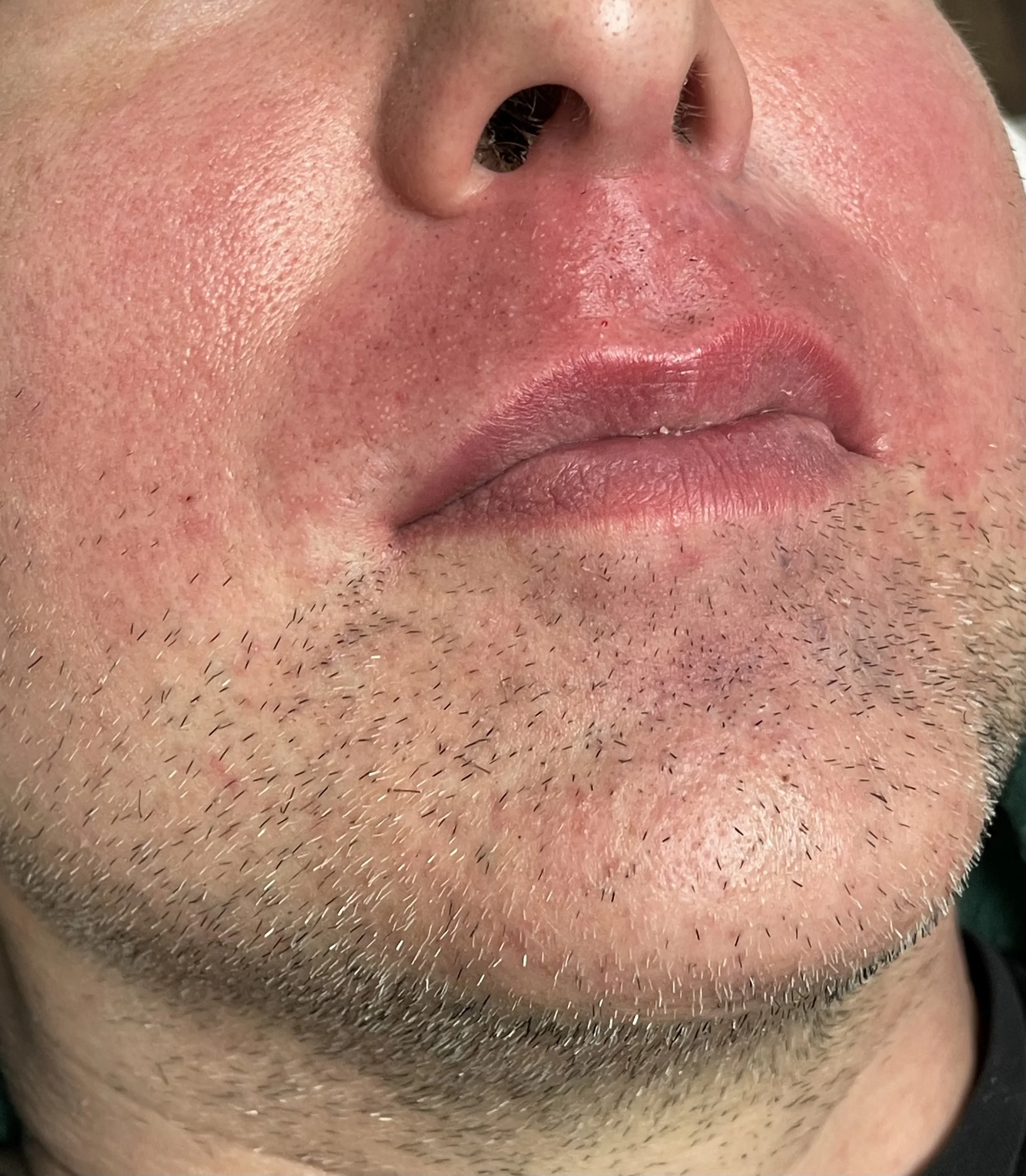 Photo shows trans client's smooth and hairless upper lip after electrolysis treatment.