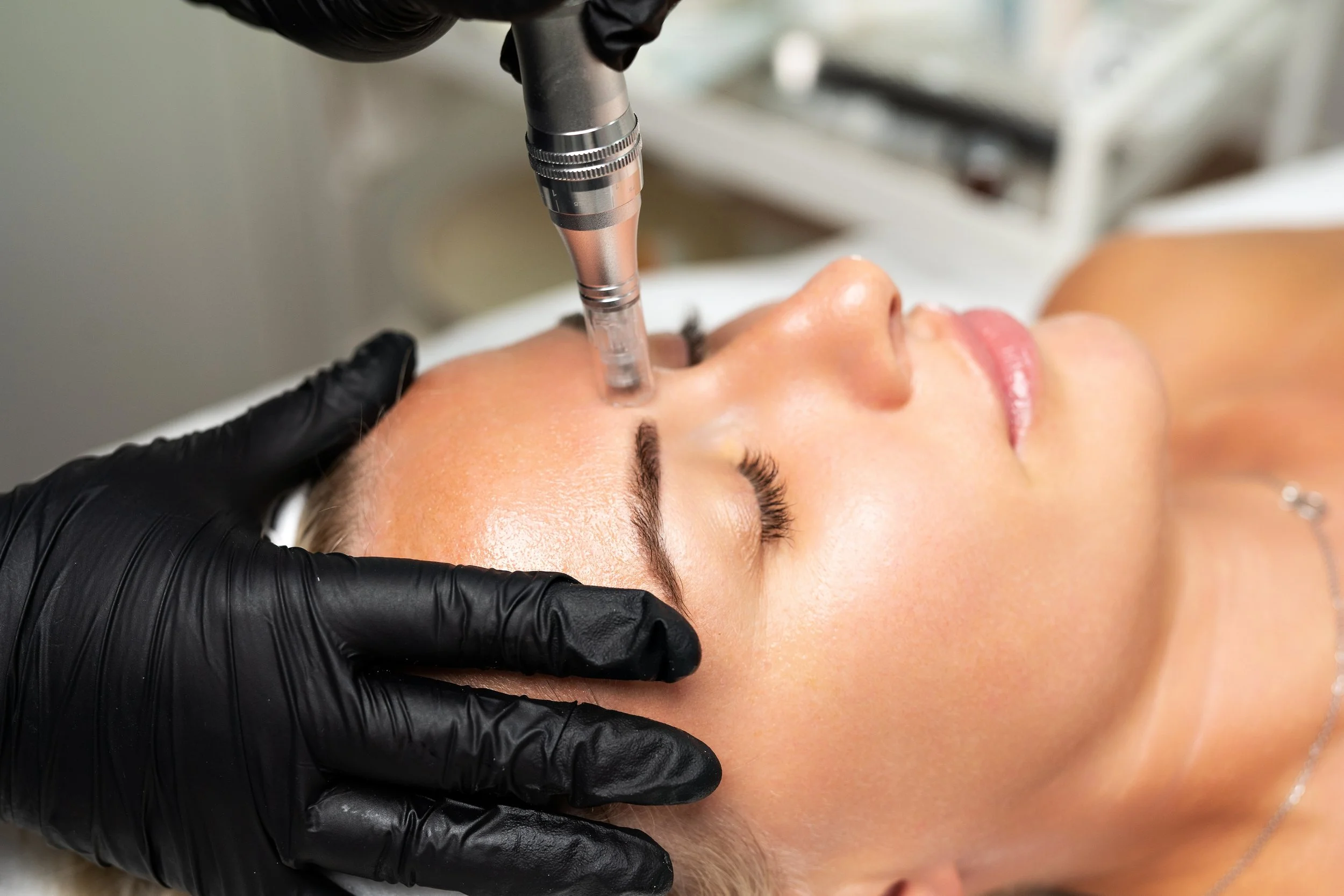 Why 4 Microneedling Treatments Are Just the Beginning: The Importance of Anti-Aging Maintenance