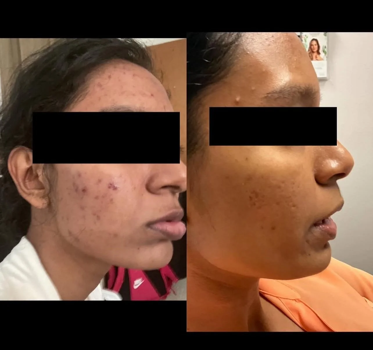 Why the End of the Holiday Season Is the Perfect Time for a Medium to                    Deep Chemical Peel