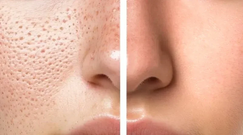 The Truth About Pore Size (and What Actually Shrinks Them)