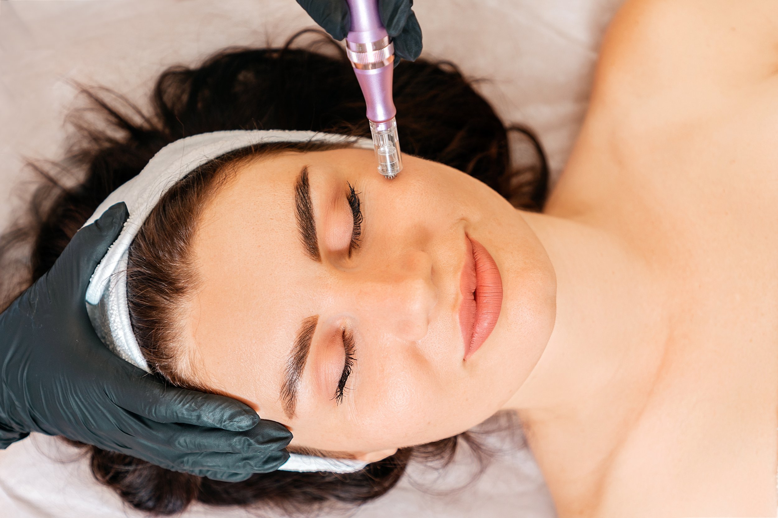 What Does Microneedling Do for You?
