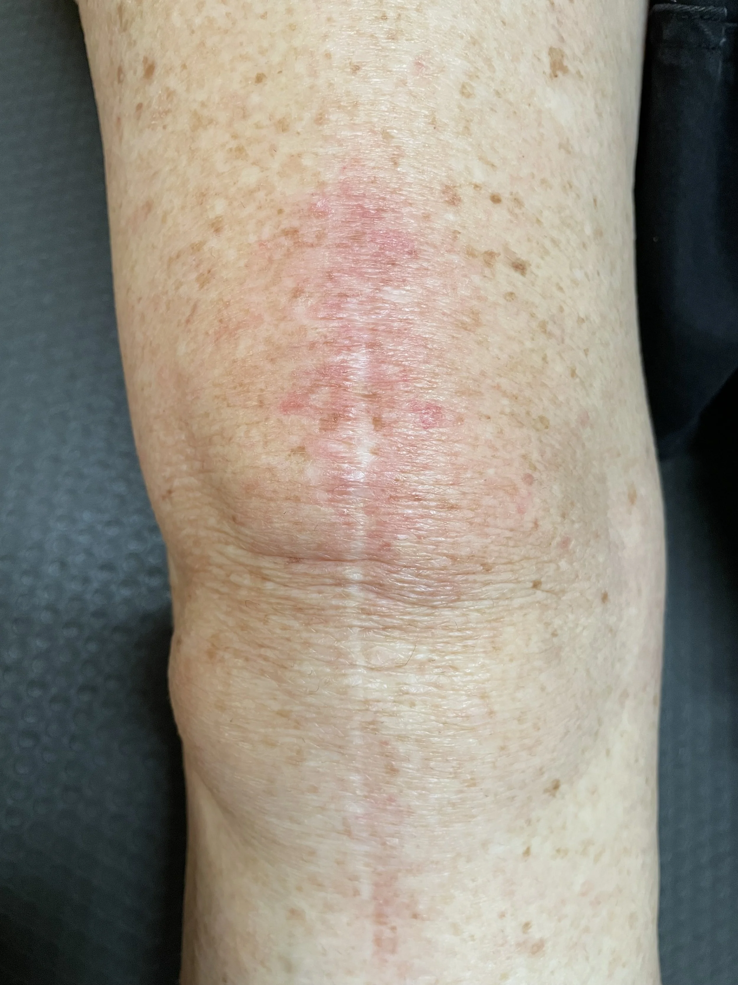 Close-up of a person's knee showing redness, inflammation, and skin irritation or rash.