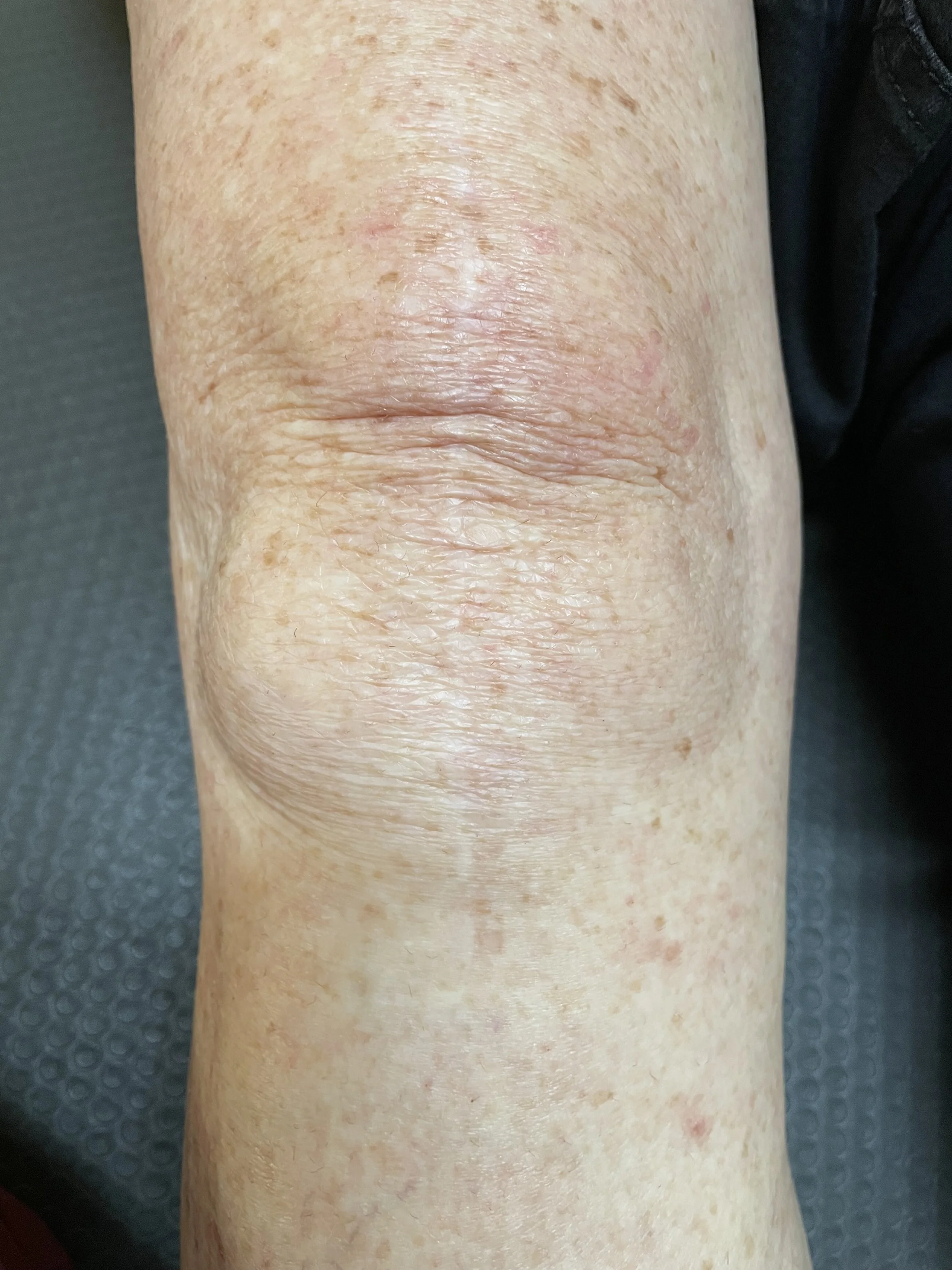 Close-up of an elderly person's knee with visible signs of aging, wrinkles, and some redness.
