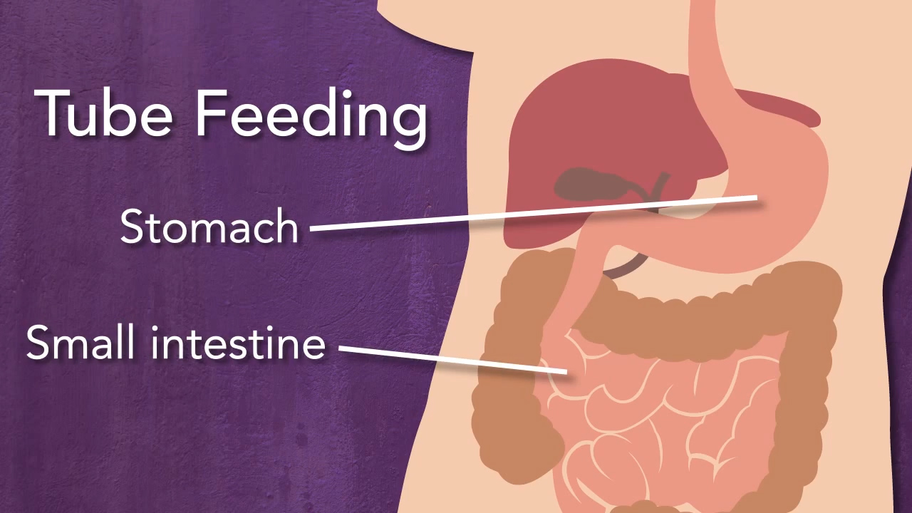 Tube Feeding