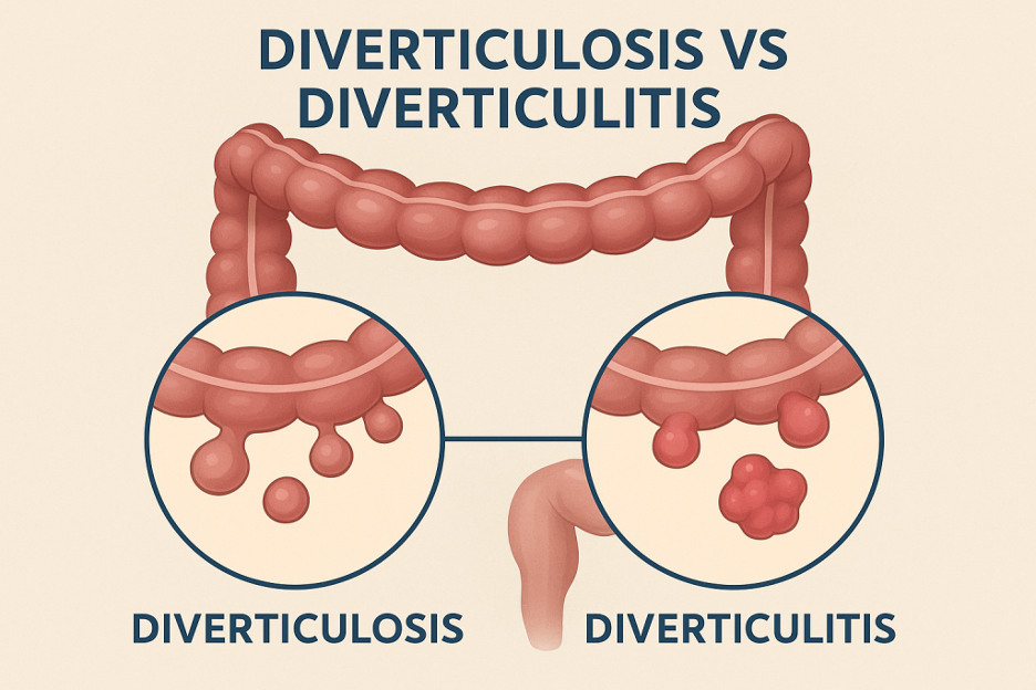 Diverticulosis vs. Diverticulitis