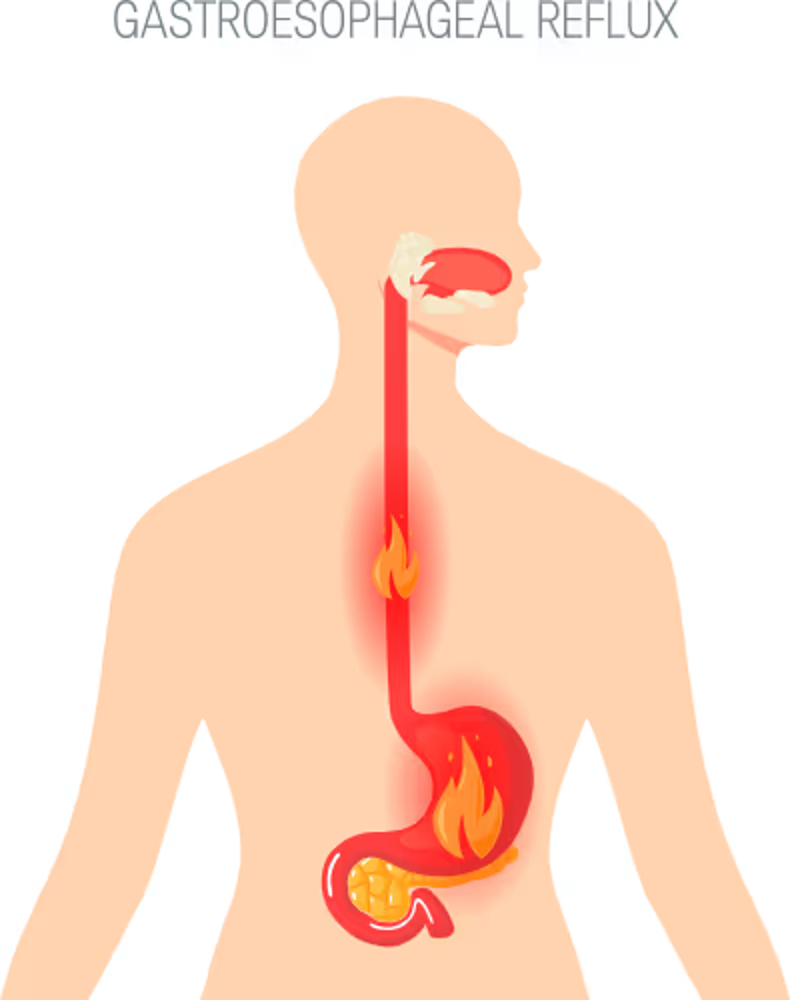 Gastroesophageal Reflux