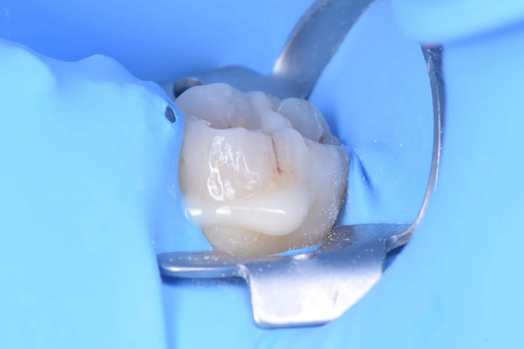 Une molaire dentaire en cours de traitement dentaire avec une digue en caoutchouc bleue autour de la dent.