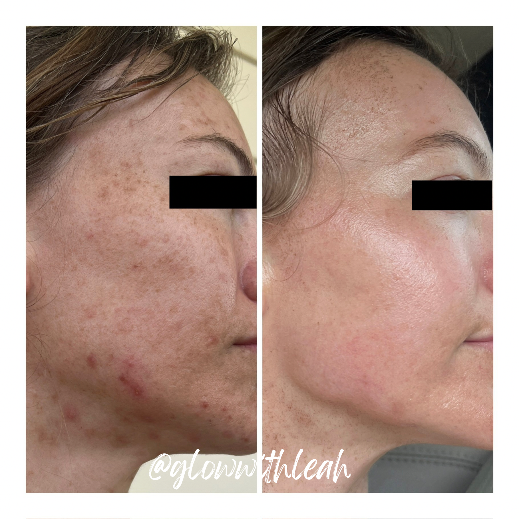 BBL HEROic + MOXI Laser Treatment in Lakewood Ranch, FL

Achieve brighter, smoother, more youthful-looking skin with a customized BBL HEROic and MOXI laser combination treatment at Glow with Leah in Lakewood Ranch, Florida. This powerful skin rejuven