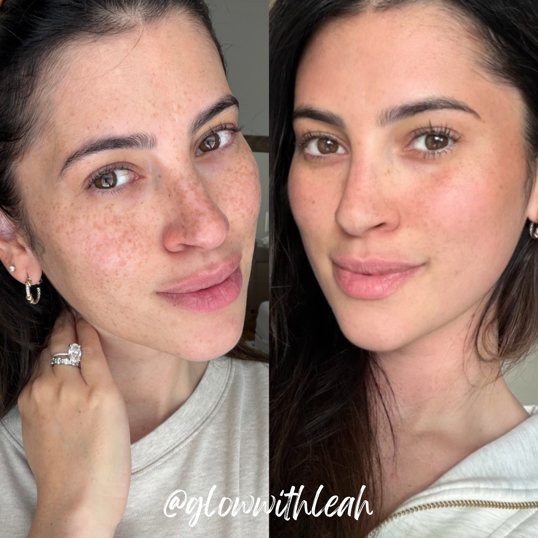 BBL HEROic + MOXI Laser Treatment in Lakewood Ranch, FL

Achieve brighter, smoother, more youthful-looking skin with a customized BBL HEROic and MOXI laser combination treatment at Glow with Leah in Lakewood Ranch, Florida. This powerful skin rejuven