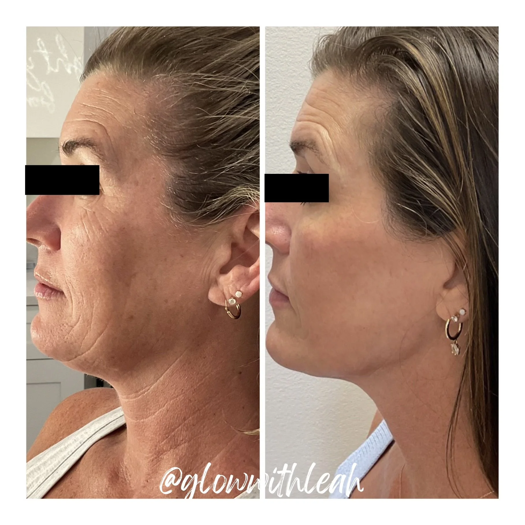 HALO TRIBRID Laser Skin Resurfacing in Lakewood Ranch, FL

Experience advanced skin rejuvenation with HALO TRIBRID laser resurfacing at Glow with Leah in Lakewood Ranch, Florida. This customized treatment combines BBL HEROic, HALO, and TRL laser tech