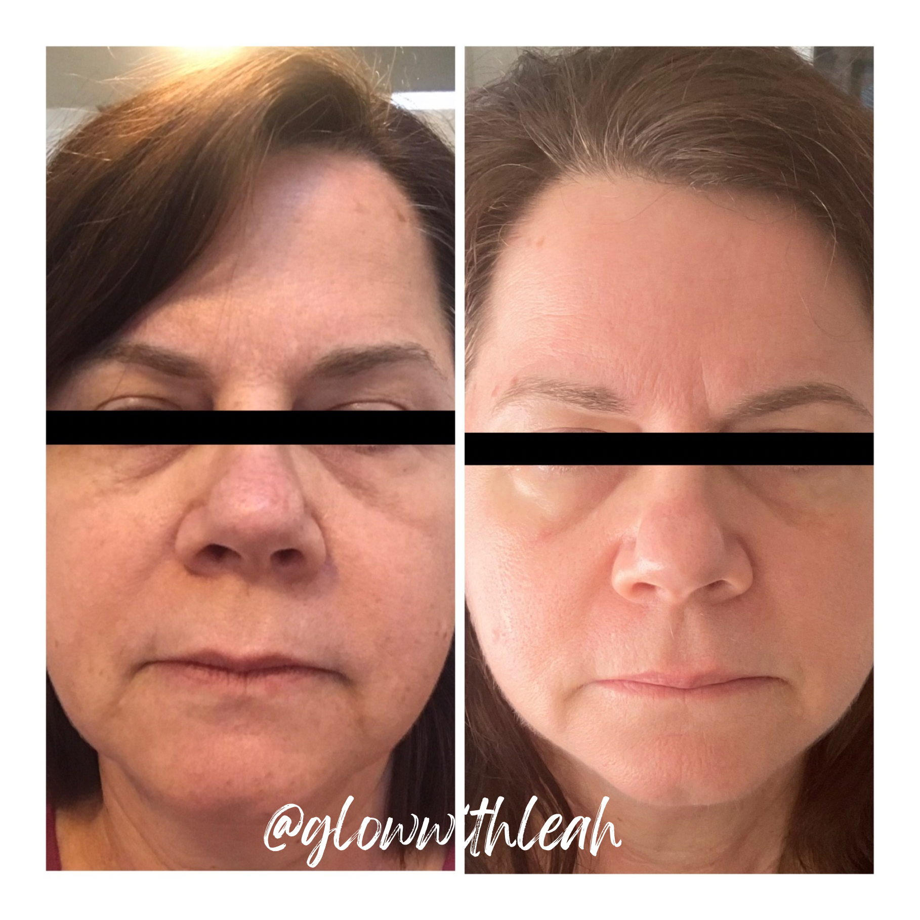 Forever Clear BBL® Before & After | Glow with Leah

Discover the transformative results of Forever Clear BBL® by Sciton at Glow with Leah in Lakewood Ranch, Florida. Our Forever Clear BBL before-and-after photos showcase how this advanced acne treatm