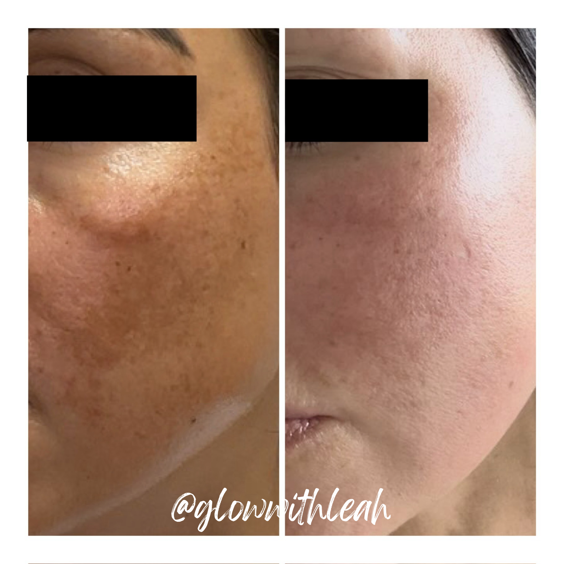 BBL® HEROic + MOXI® Laser Before & After | Glow with Leah

See the incredible transformation possible with a customized BBL® HEROic and MOXI® laser treatment at Glow with Leah in Lakewood Ranch, Florida. This powerful laser combination is designed to