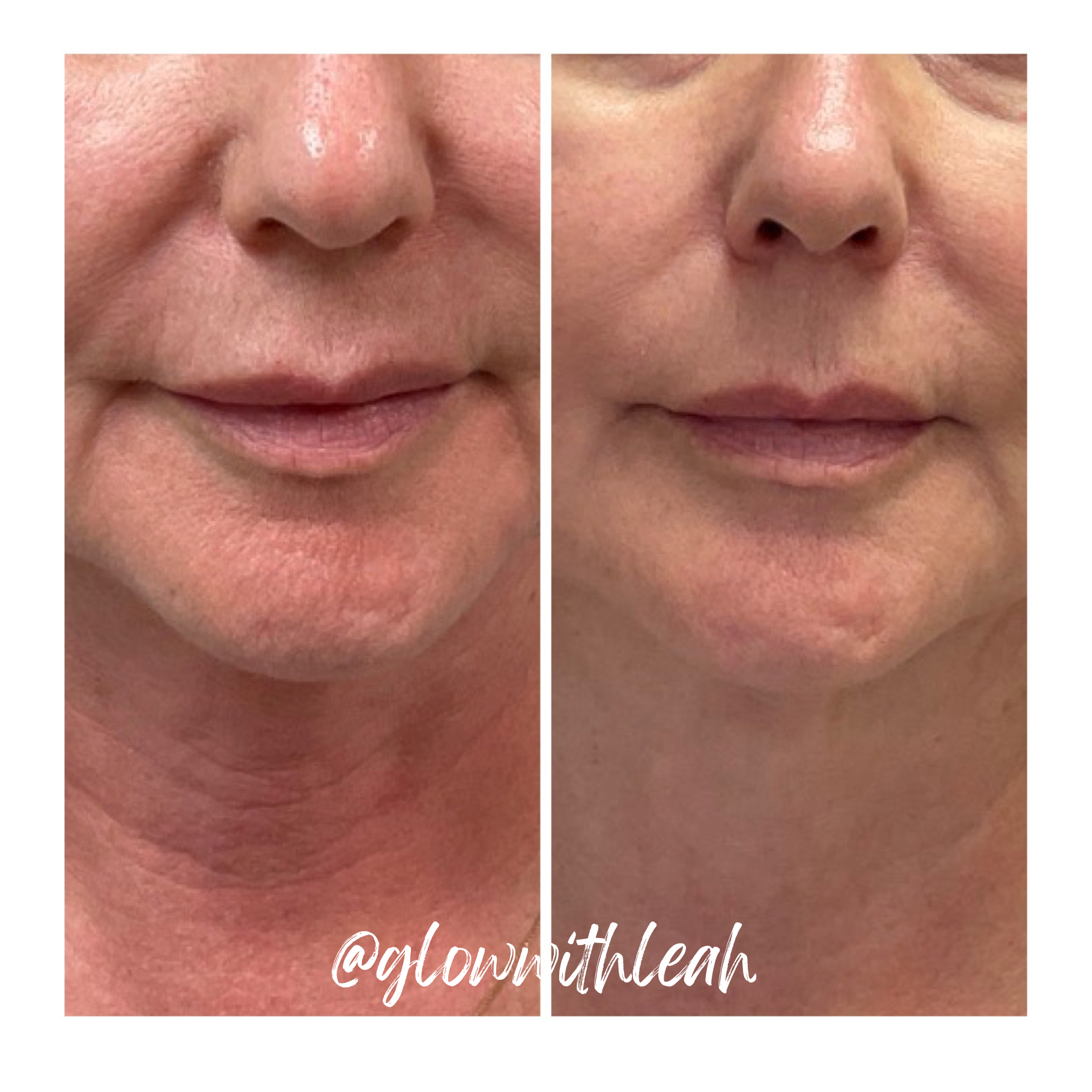 BBL® HEROic Before & After for Redness Reduction | Glow with Leah

See the remarkable improvement in skin redness with BBL® HEROic by Sciton at Glow with Leah in Lakewood Ranch, Florida. Our BBL HEROic redness reduction before-and-after photos showca