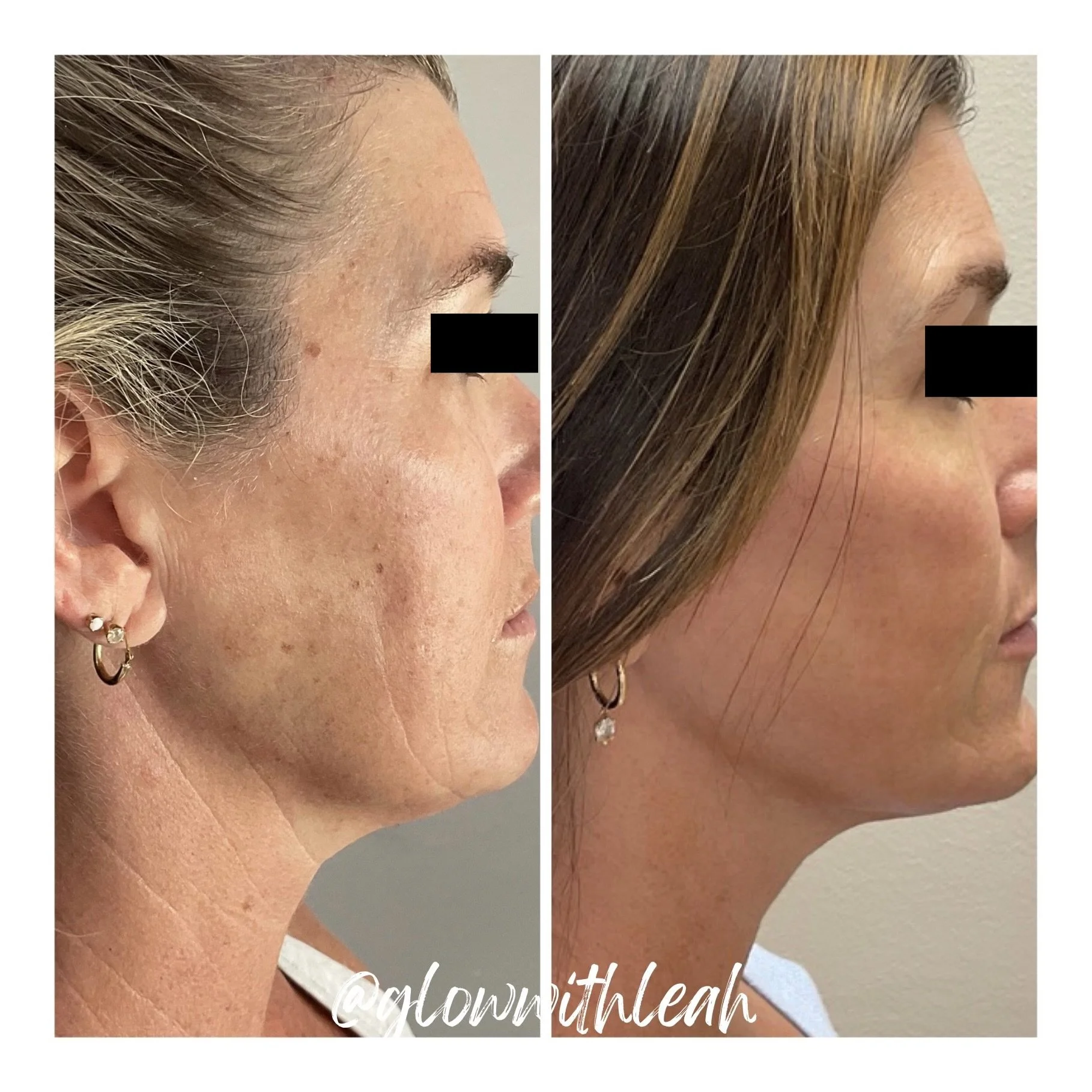 HALO TRIBRID Laser Skin Resurfacing in Lakewood Ranch, FL

Experience advanced skin rejuvenation with HALO TRIBRID laser resurfacing at Glow with Leah in Lakewood Ranch, Florida. This customized treatment combines BBL HEROic, HALO, and TRL laser tech