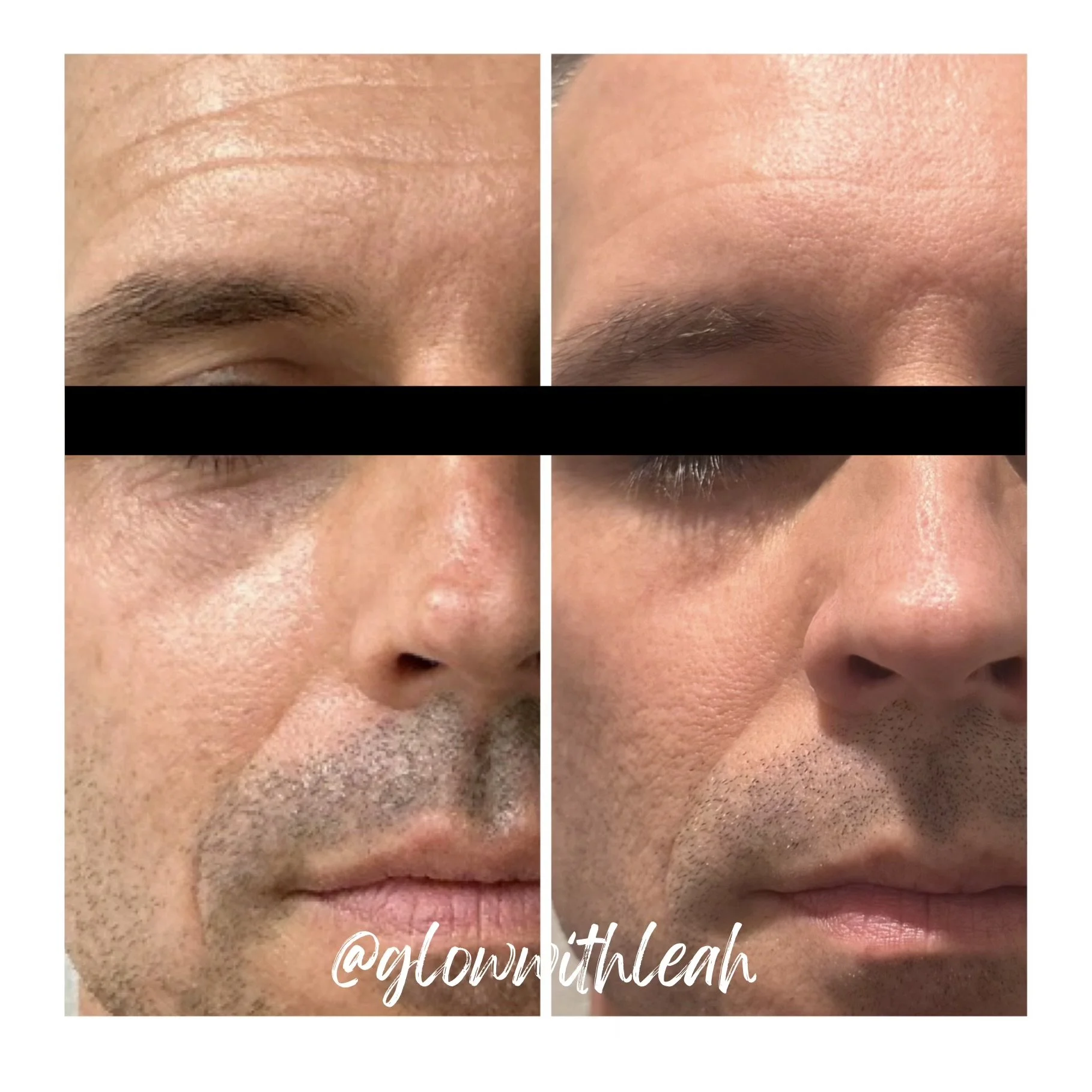  HALO® Tribrid™ Before & After

See the incredible transformation with our HALO Tribrid laser treatment at Glow with Leah in Lakewood Ranch, FL. This advanced laser skin resurfacing treatment helps improve sun damage, fine lines, wrinkles, acne scars