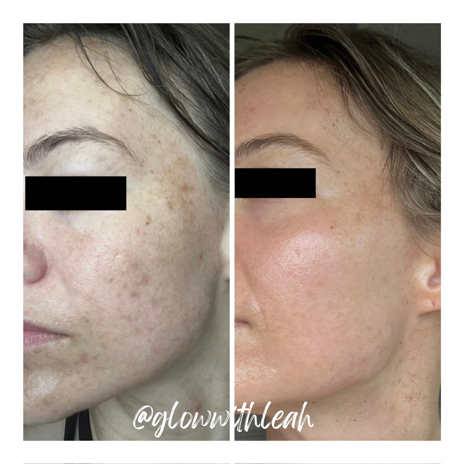 BBL HEROic + MOXI Laser Treatment in Lakewood Ranch, FL

Achieve brighter, smoother, more youthful-looking skin with a customized BBL HEROic and MOXI laser combination treatment at Glow with Leah in Lakewood Ranch, Florida. This powerful skin rejuven