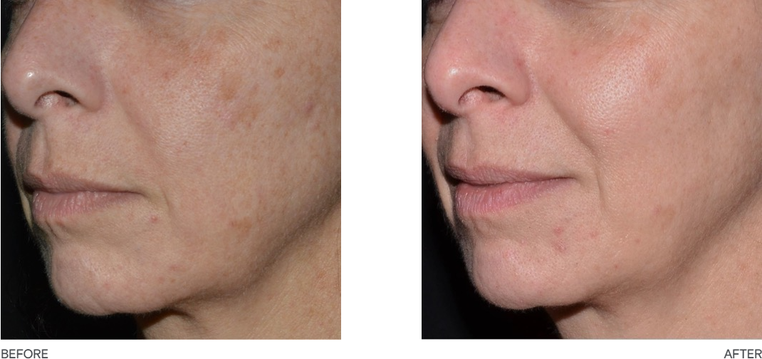 Photos from Lutronic website using Ultra Laser