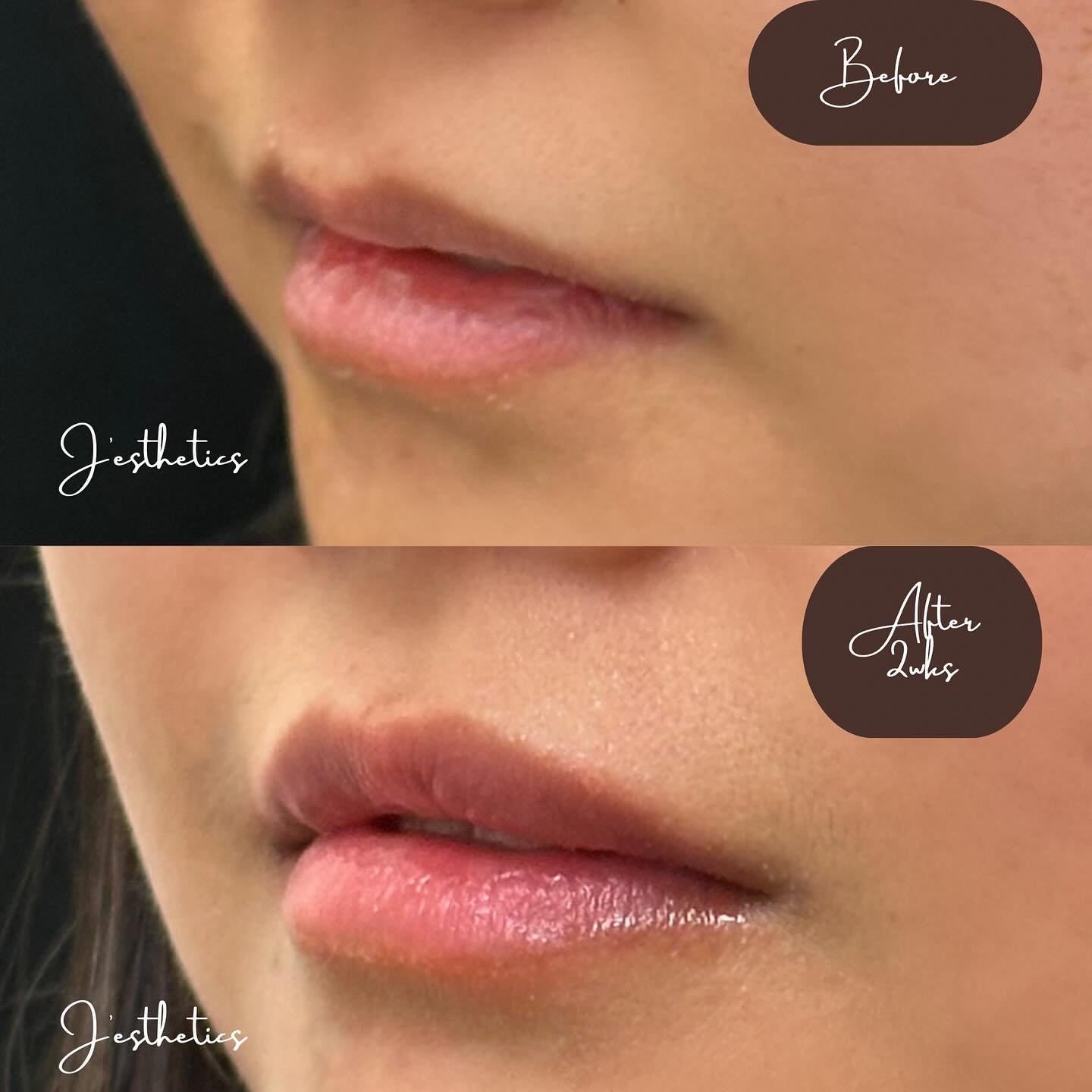 💋 Lips by J&rsquo;esthetics 💋
Our brand aims to enhance your beauty keeping it natural (no 🦆, no overfilling in our medspa)

Our first-time client placed her trust in us, allowing us to sculpt her lips with finesse and precision. With our expertis
