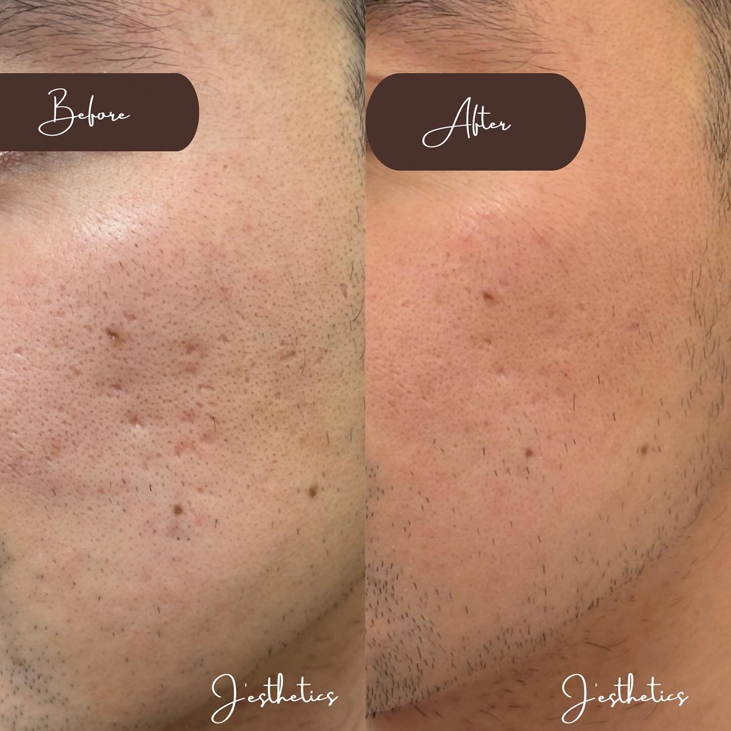 ✨Microneedling✨
Got acne scars? Large pores? Microneedling might be the solution for you! Book your free consultation today to explore all our options that fit all your beauty goals💕 

Before photo: before any treatment 
After photo: after 2 rounds 