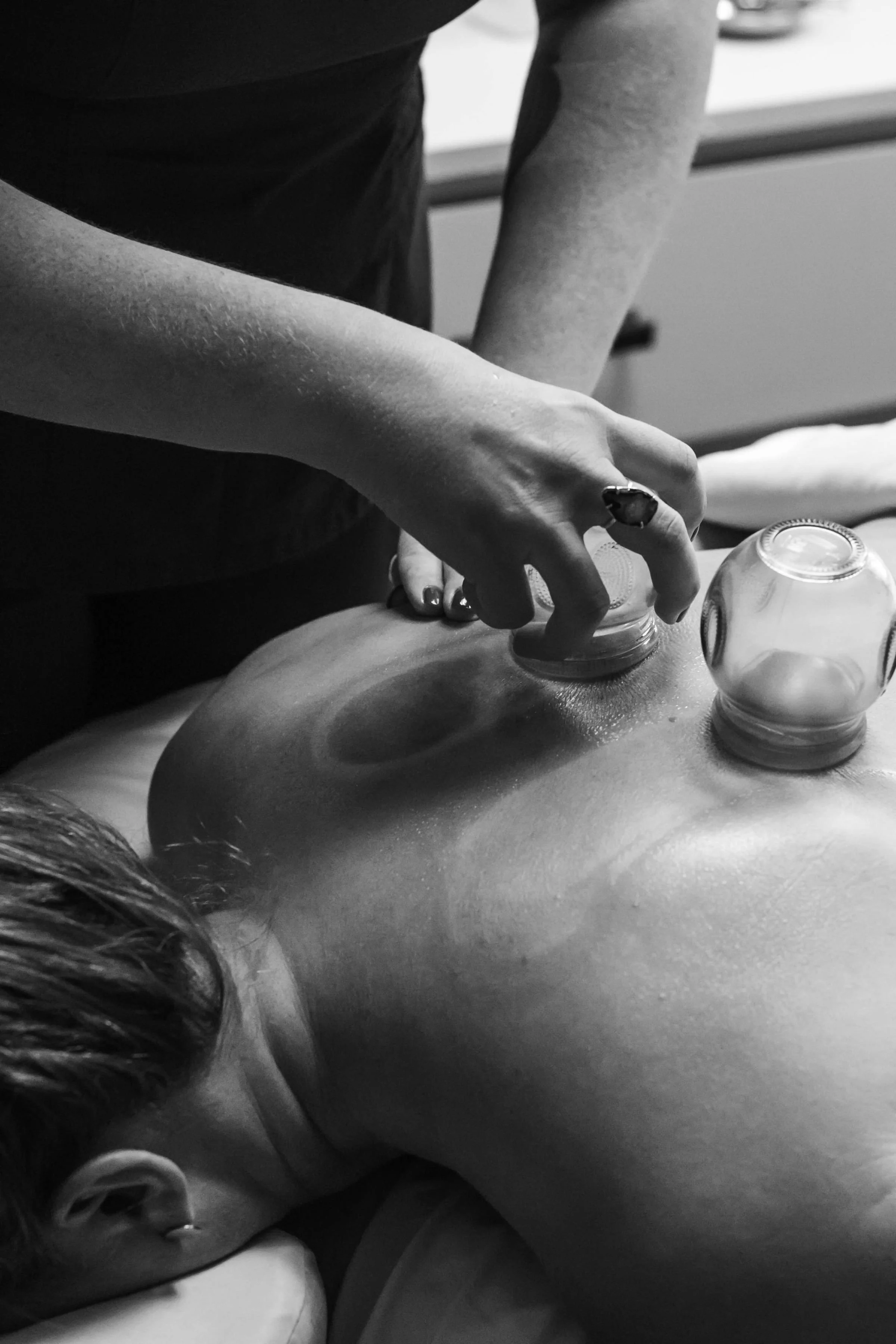 Person receiving a cupping therapy on their back. Kirkland, Washington. Vancouver, Washington. Mental health. Women's health. Fertility. Menopause. Microneedling. Cosmetic acupuncture.