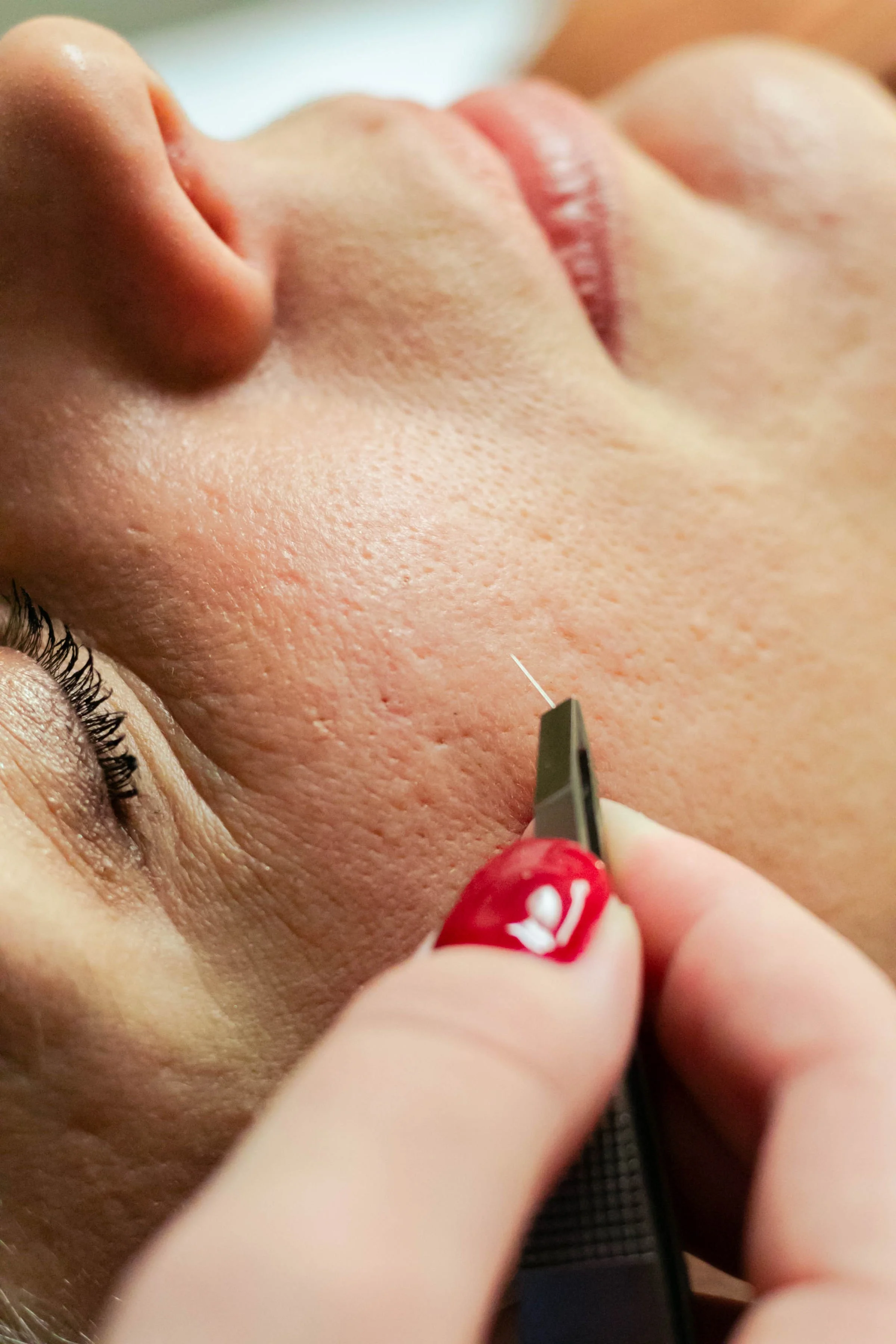 Close-up of a person undergoing a cosmetic acupuncture. Kirkland, Washington. Vancouver, Washington. Mental health. Women's health. Fertility. Menopause. Microneedling. Cosmetic acupuncture.