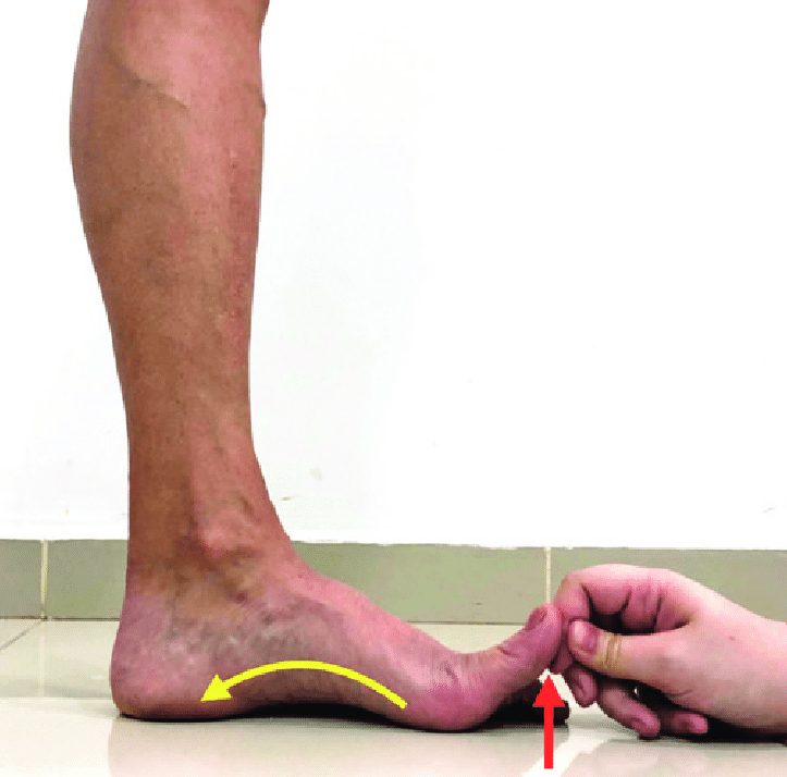 The Hidden Key to Foot Function: The Importance of Big Toe Flexion in Foot Pain and Gait