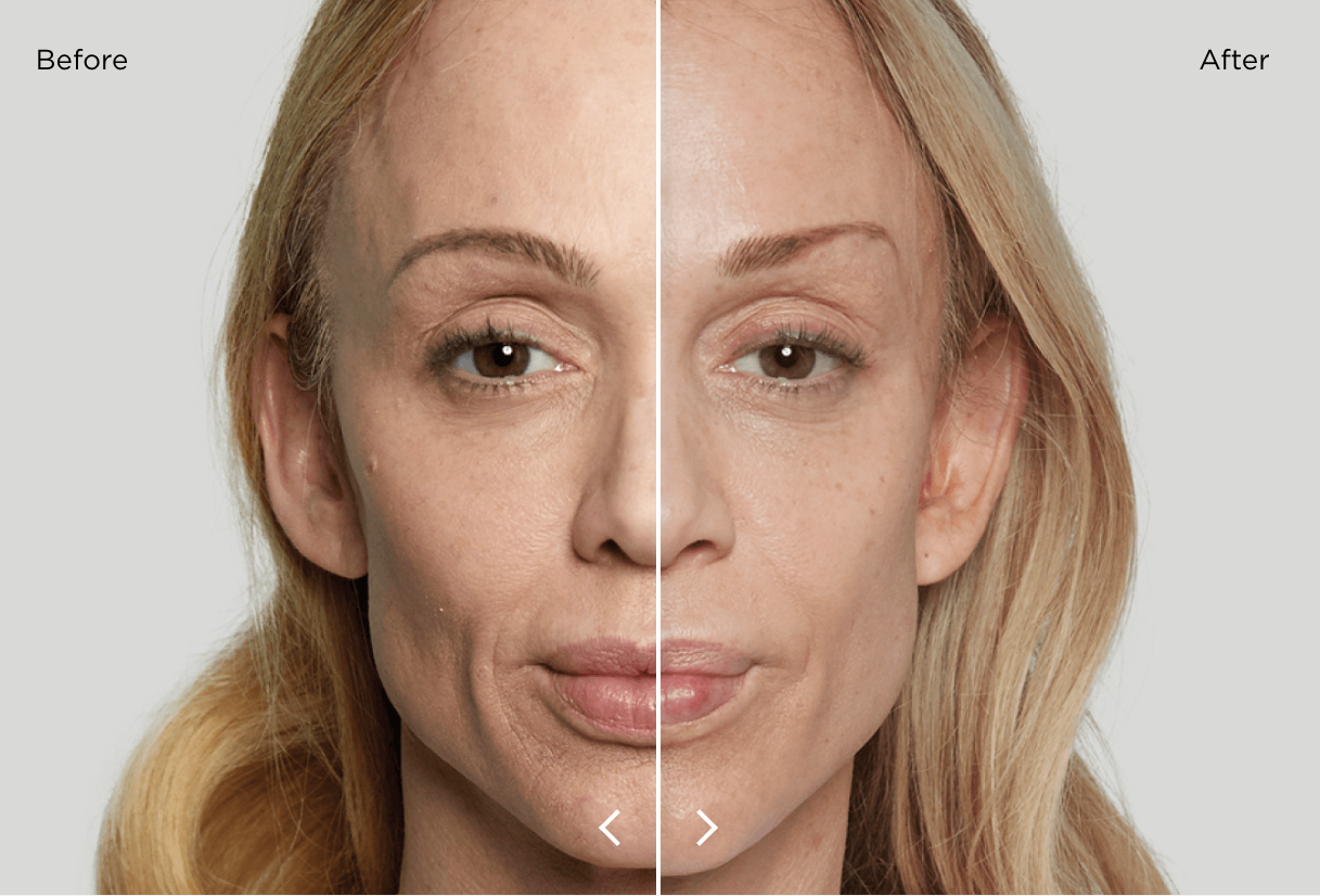 Split image showing a woman's face before and after treatment, highlighting skin improvement.